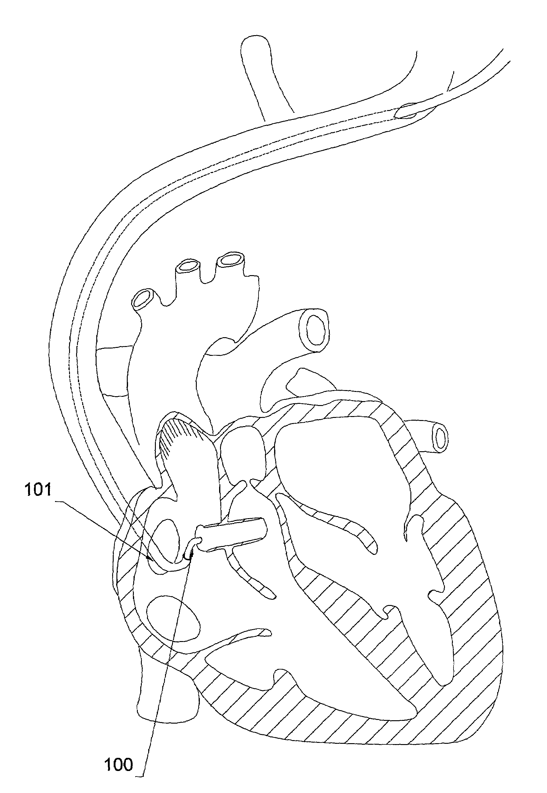 Telescoping guide catheter with peel-away outer sheath