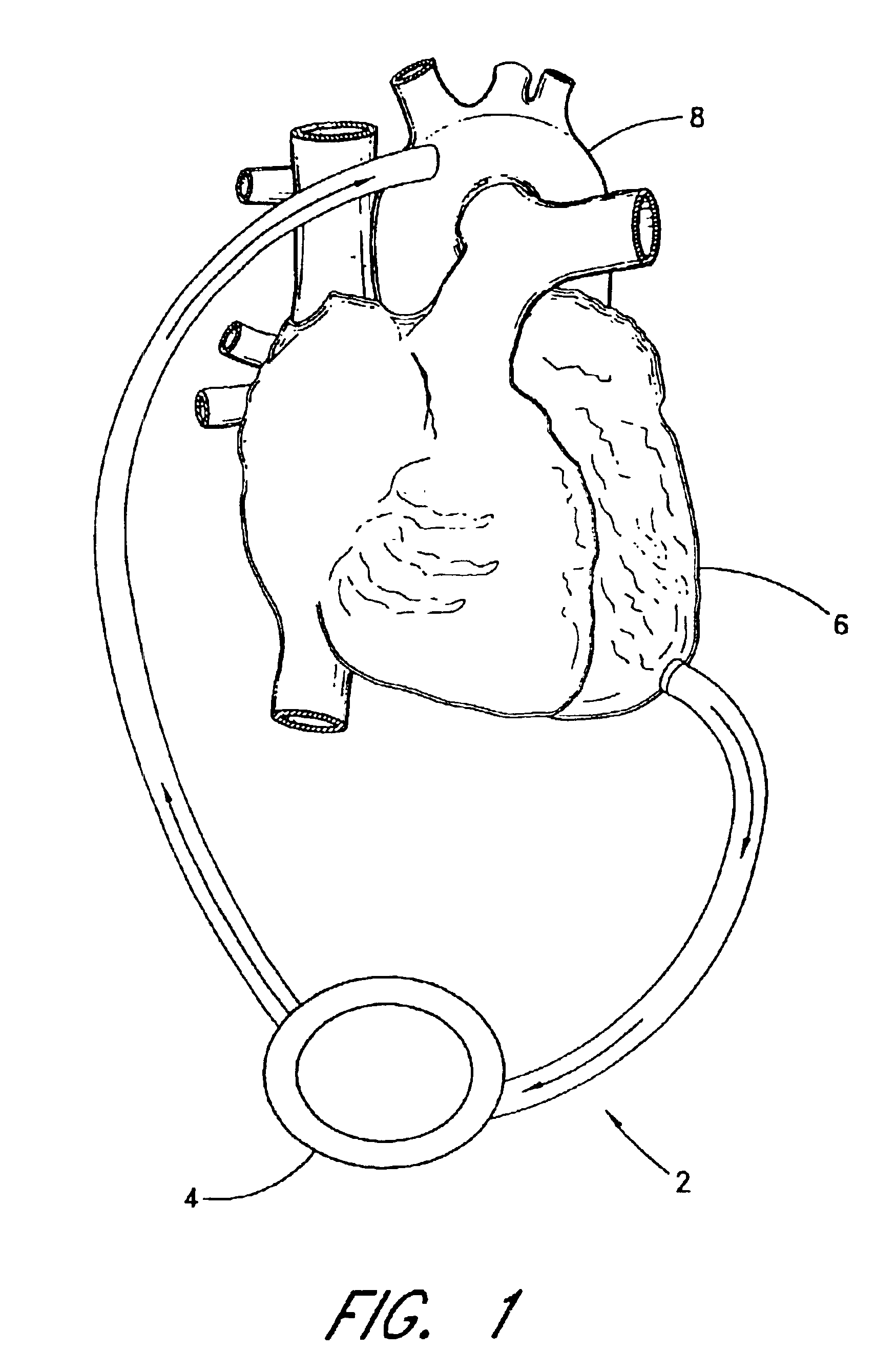 Implantable heart assist system and method of applying same