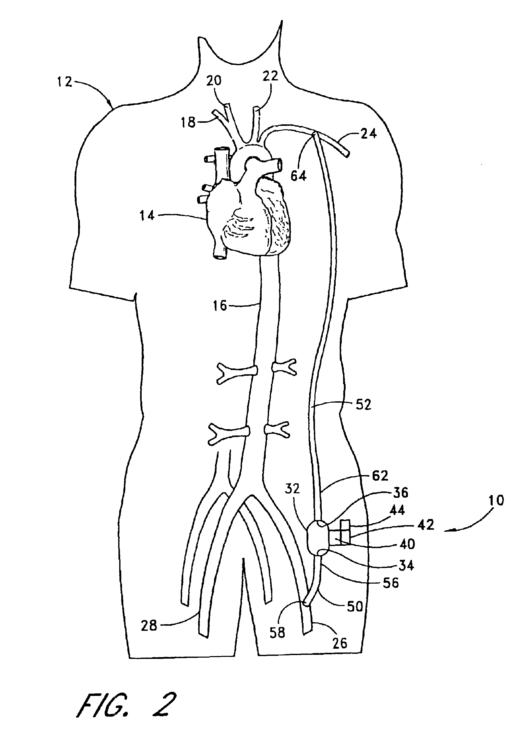 Implantable heart assist system and method of applying same