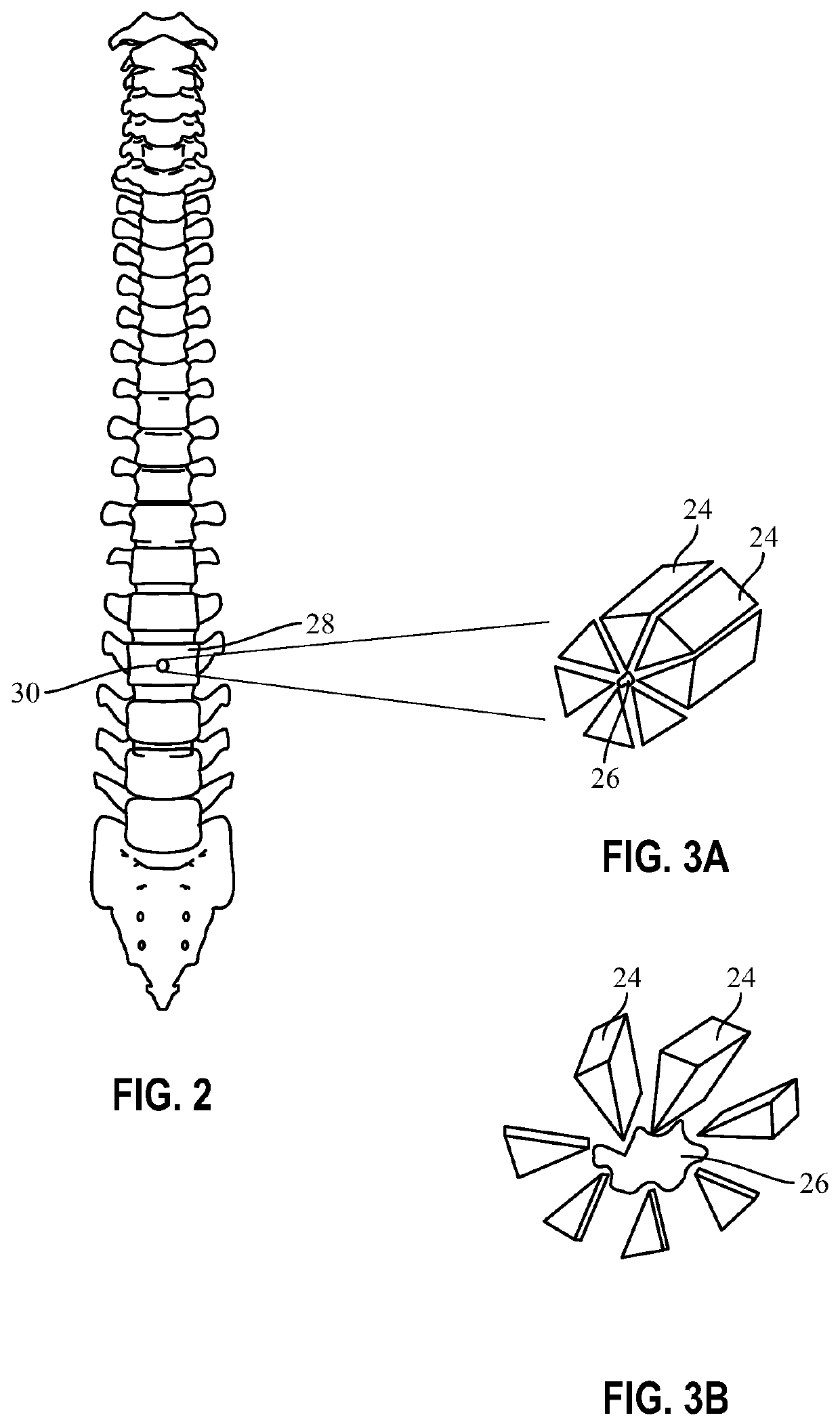 Brachytherapy stent configurations