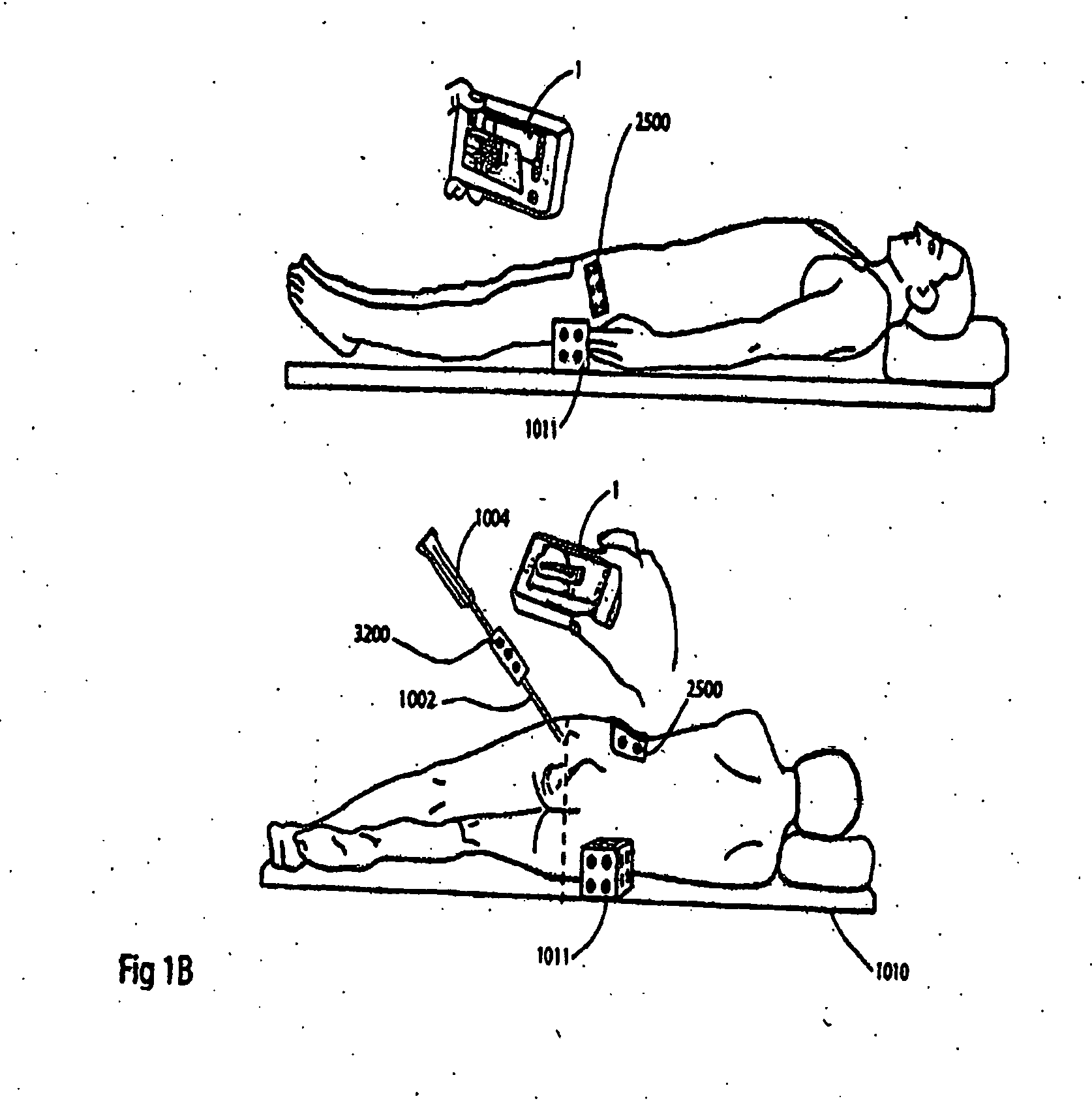 Handheld tracking system and devices for aligning implant systems during surgery