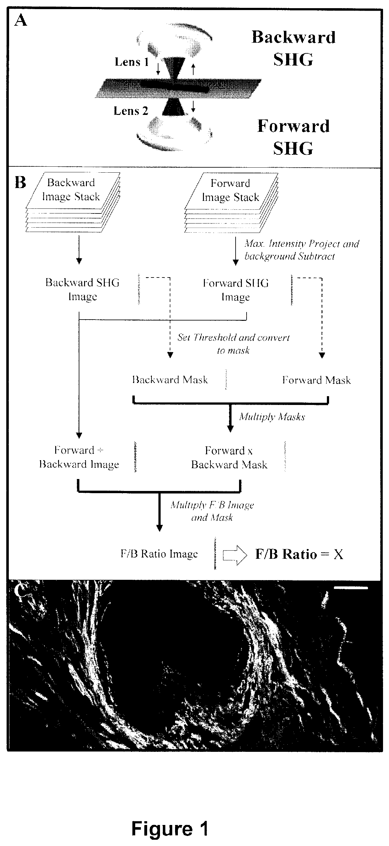 Method and apparatus to diagnose the metastatic or progressive potential of cancer, fibrosis and other diseases