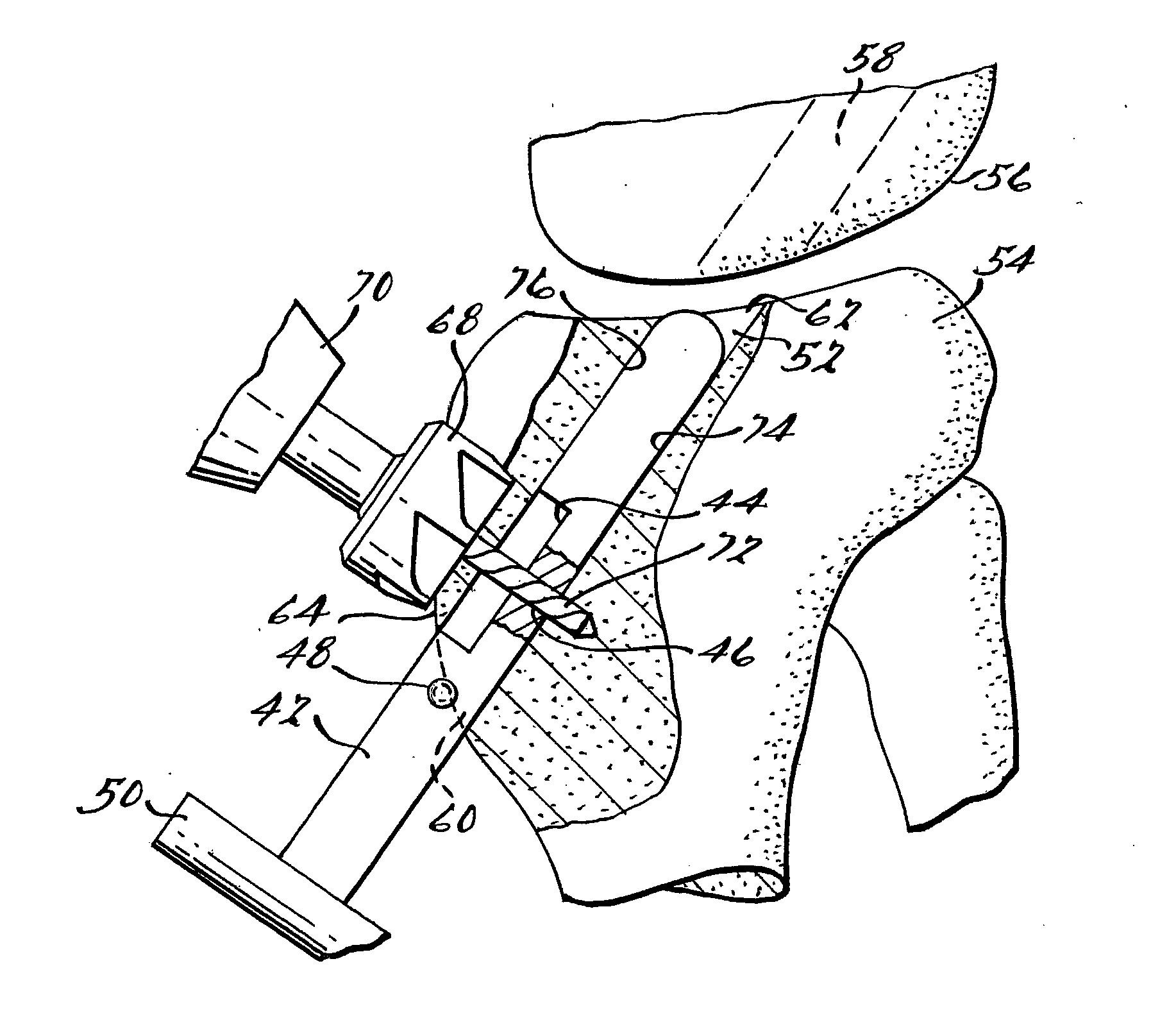 Apparatus and Method for Tibial Fixation of Soft Tissue