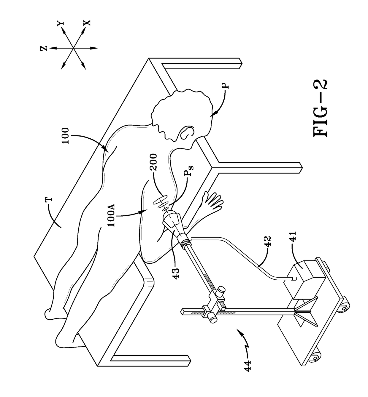 Treatments for blood sugar levels and muscle tissue optimization using extracorporeal acoustic shock waves