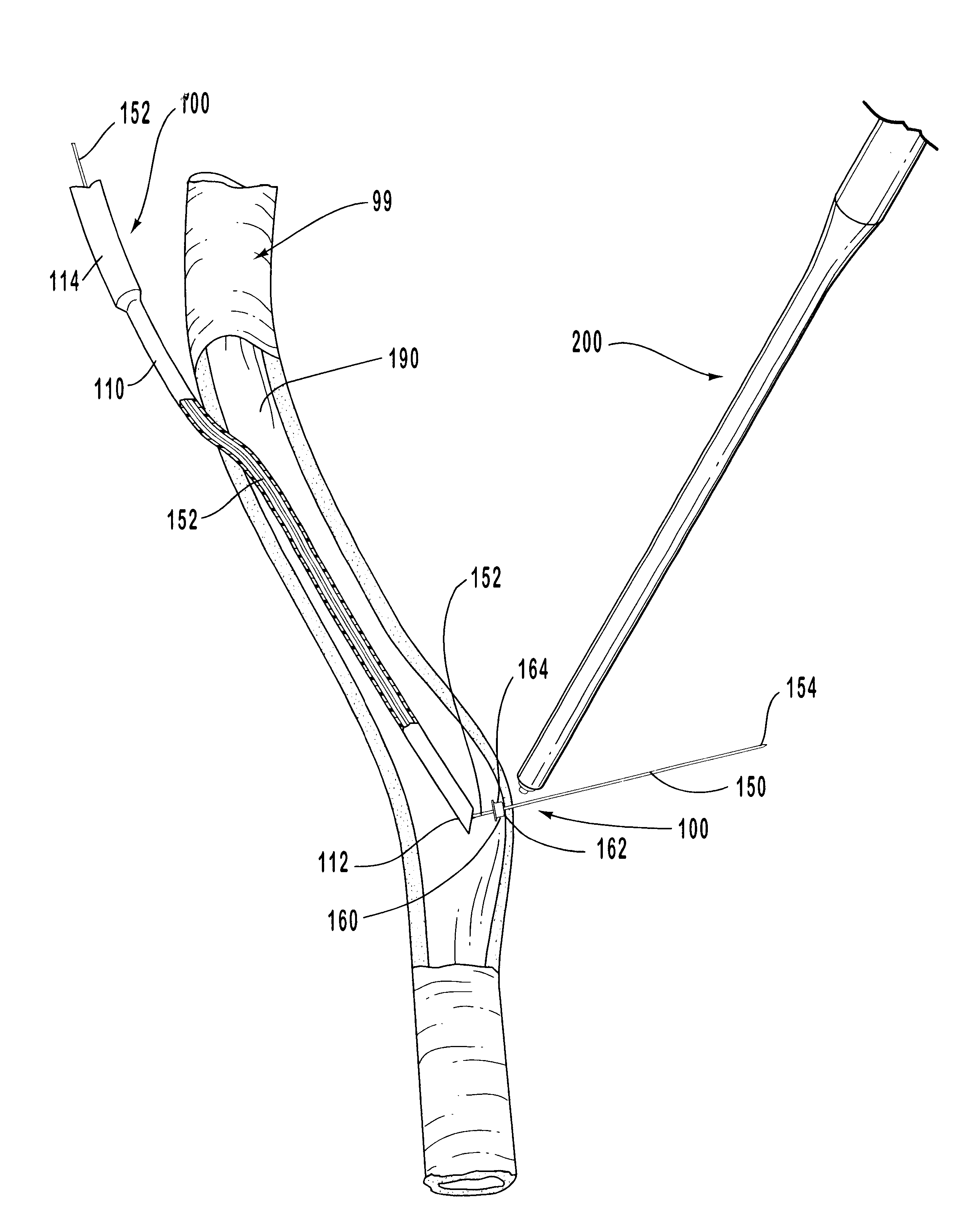 Methods and systems for intraluminally directed vascular anastomosis