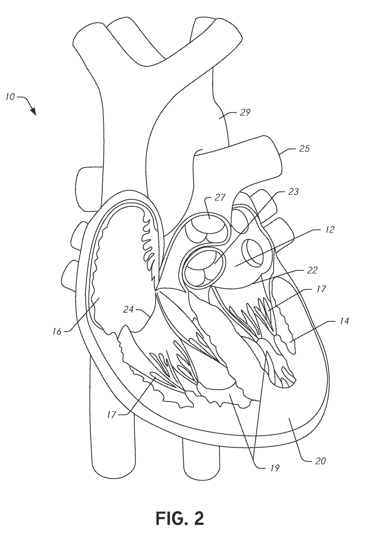 Method and apparatus for cardiac procedures