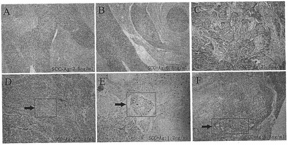 Method for predicting sensitivity of cervical cancer patient subjected to paclitaxel and cis-platinum adopted chemotherapy