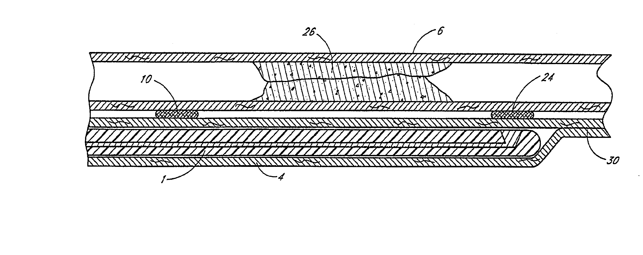 Apparatus and method for performing laser-assisted vascular anastomoses using bioglue