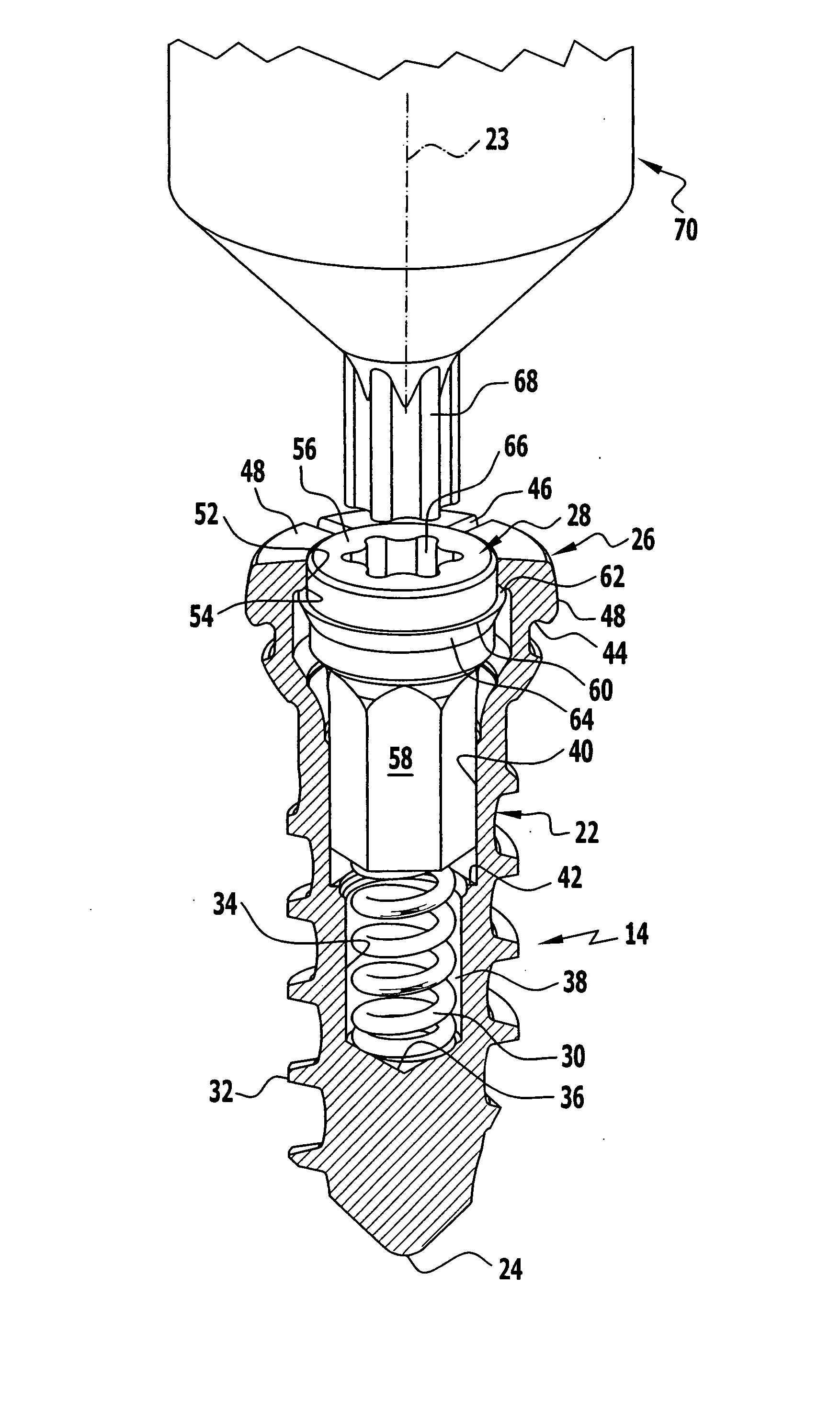 Bone Screw