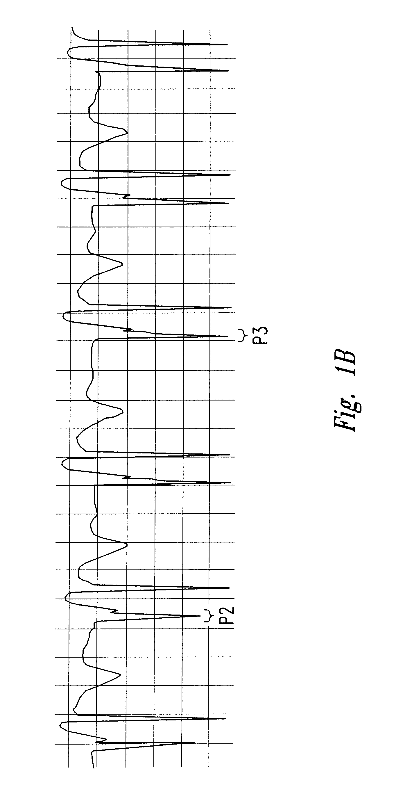 Method of locating the tip of a central venous catheter