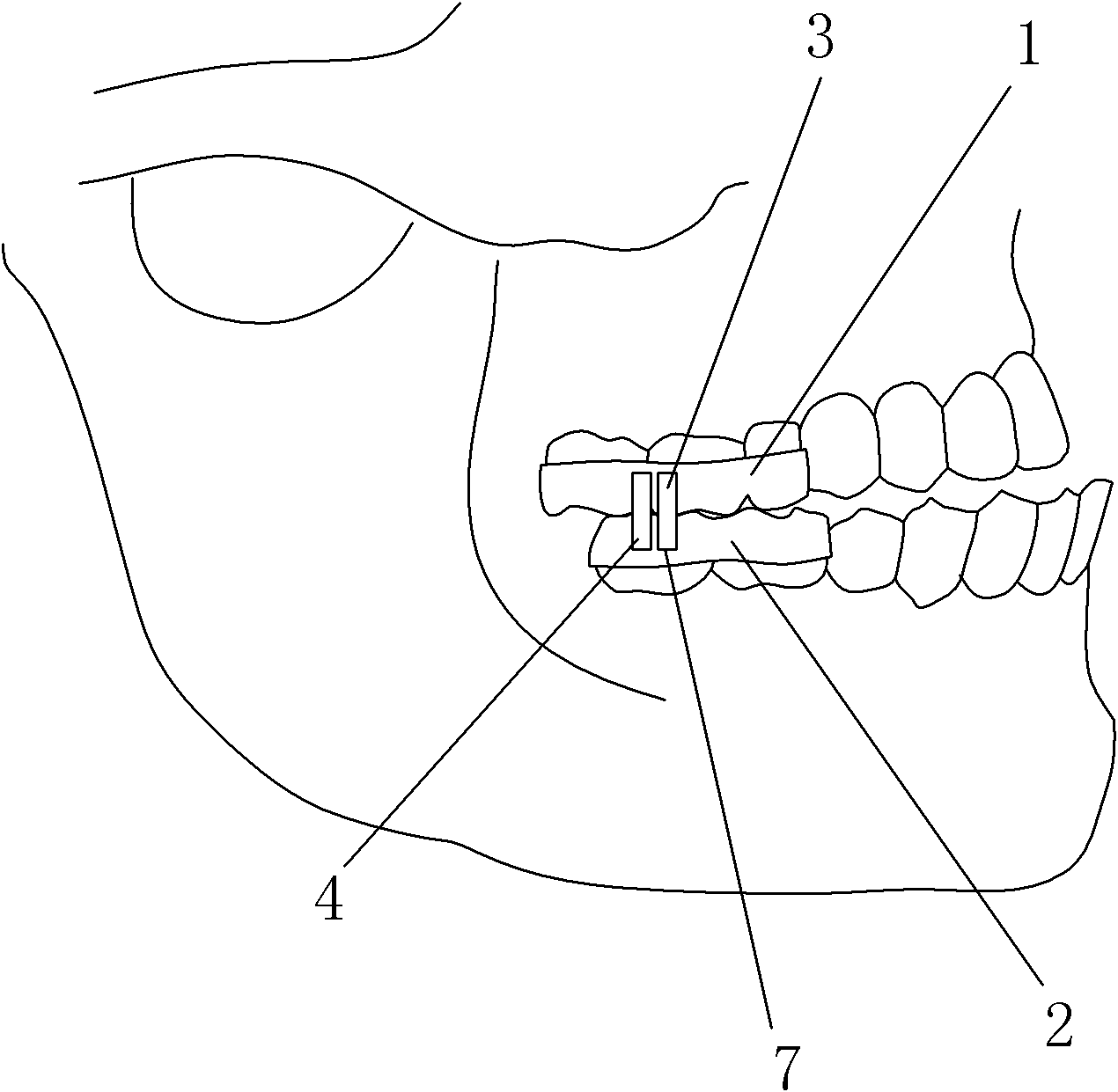 Skeletal III-type malocclusion appliance