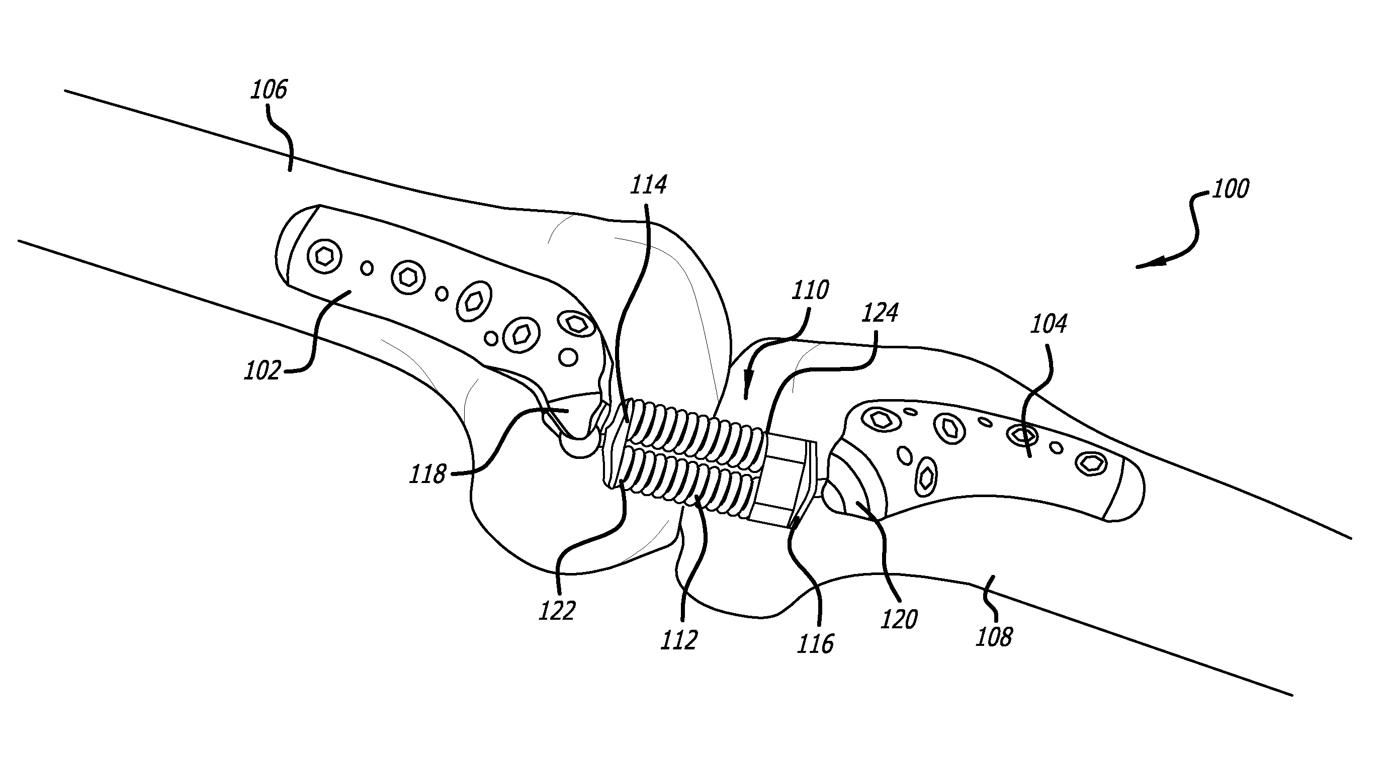 Adjustable Absorber Designs For Implantable Device