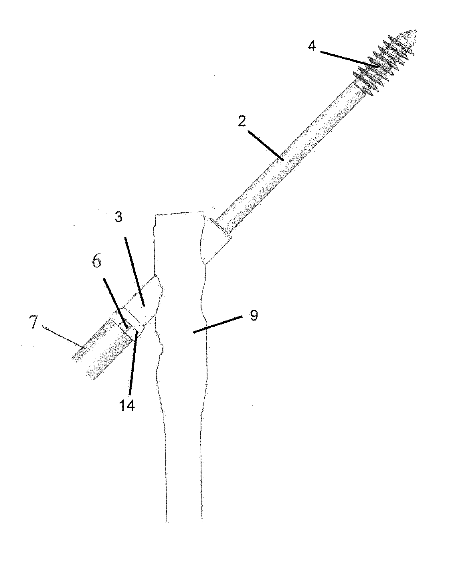 Method for connecting fractured bone