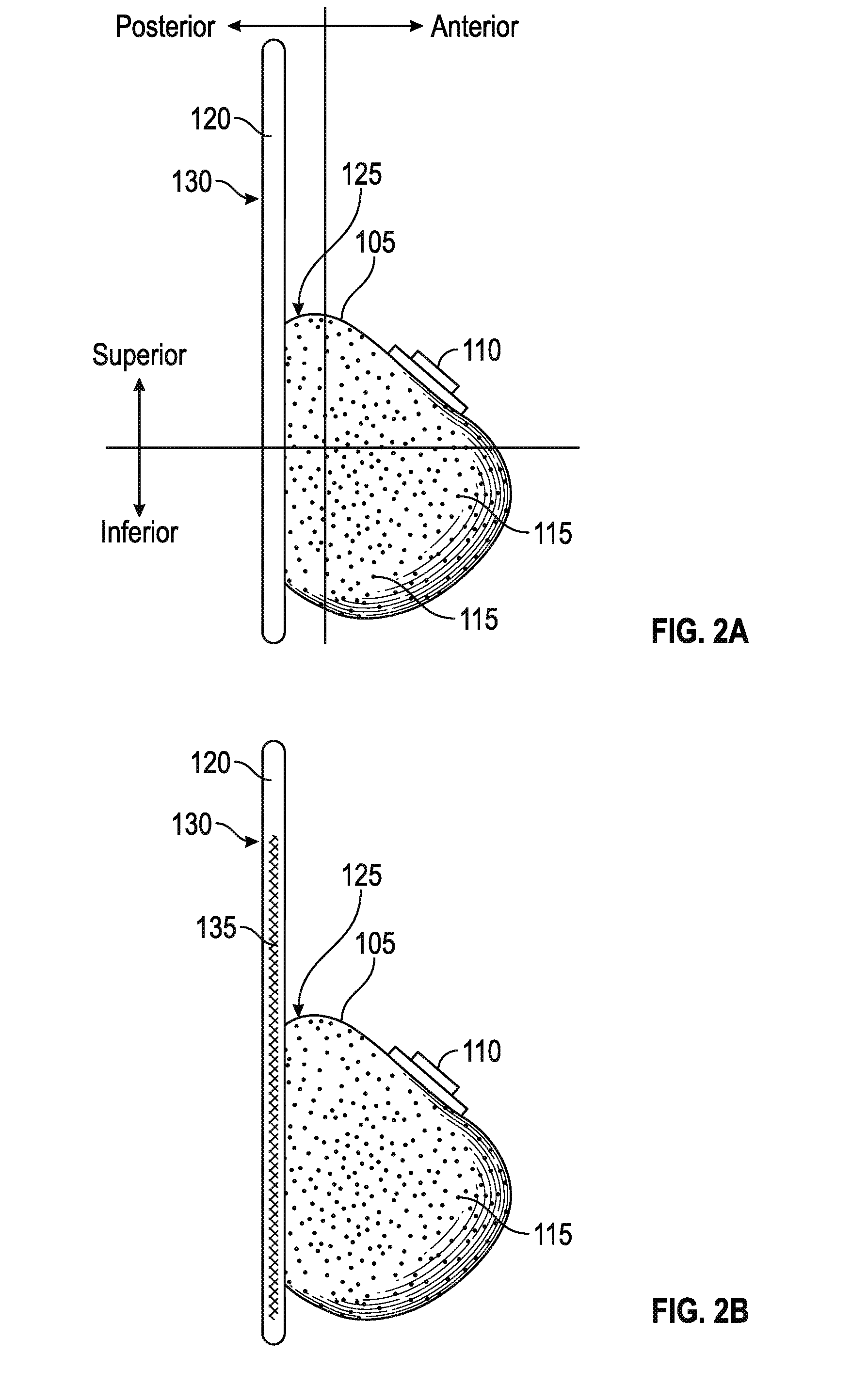 Systems and methods for a tissue expander