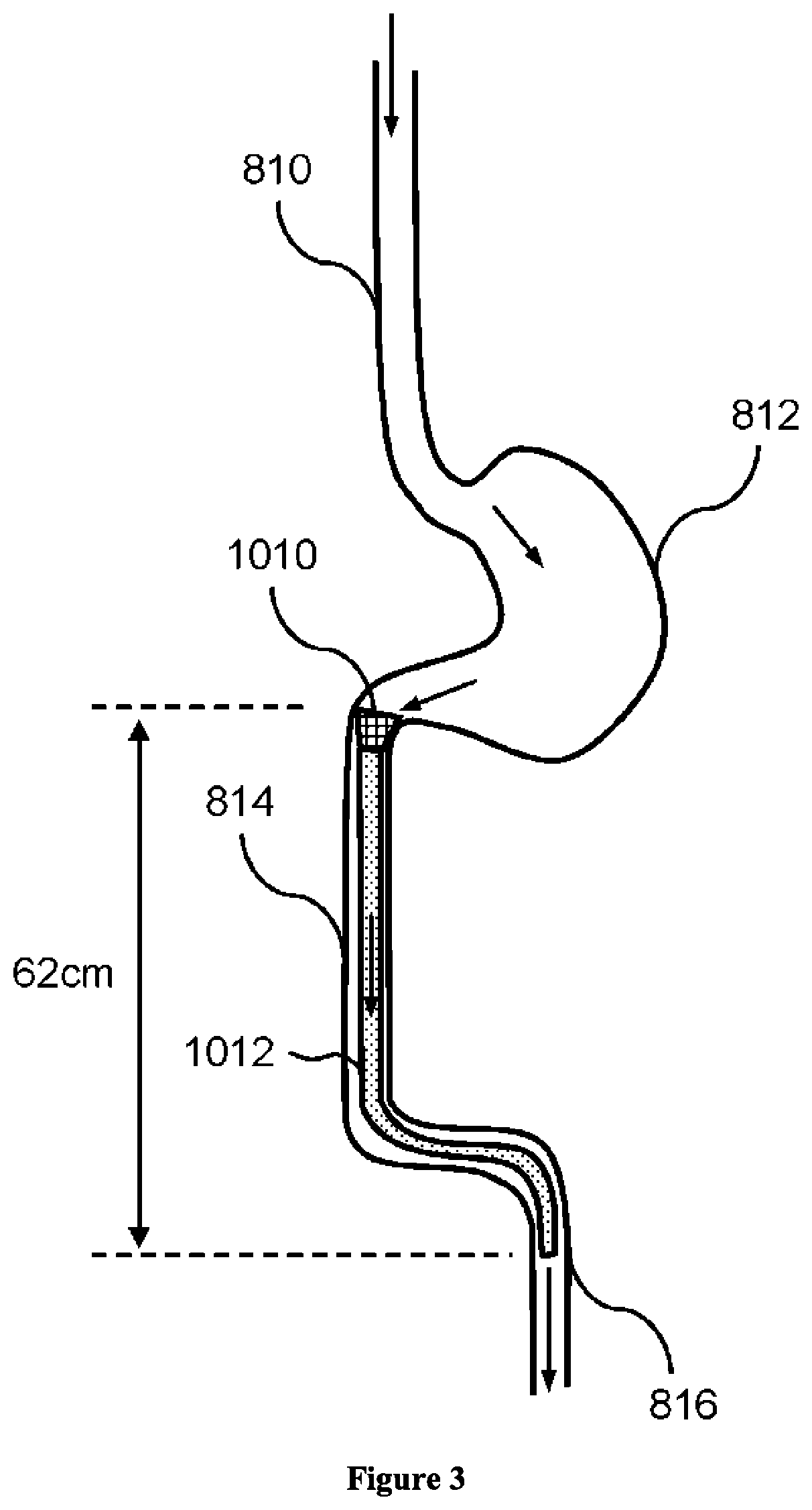 Composition and method for treatment of metabolic disorders