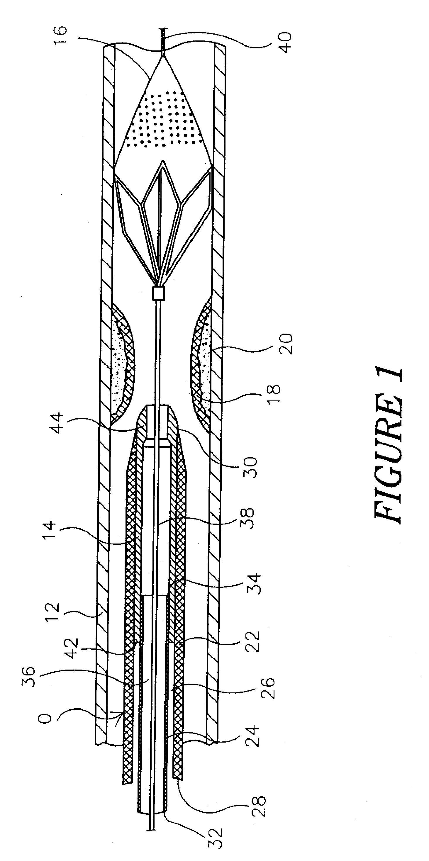 Hydraulic controlled retractable tip filter retrieval catheter