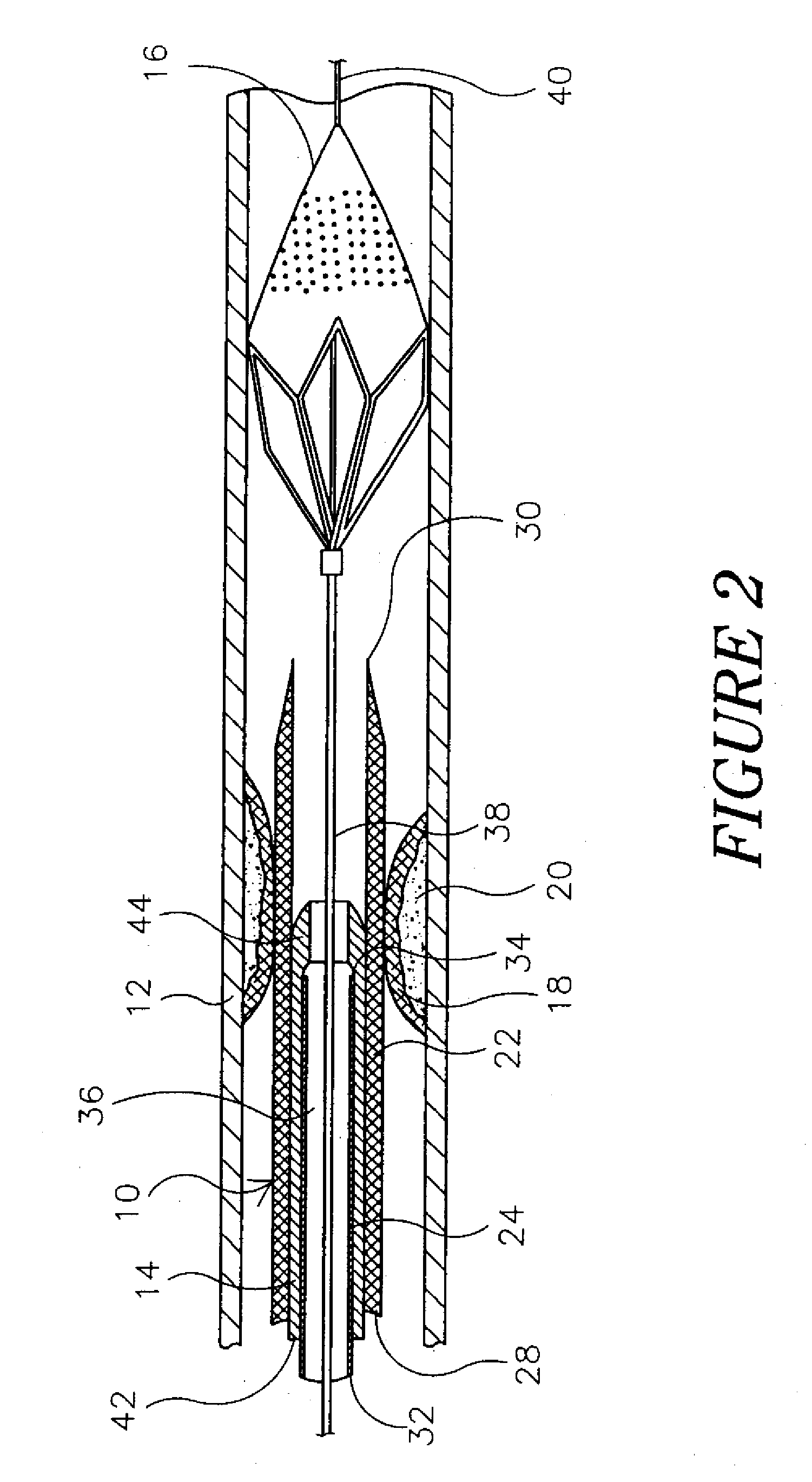 Hydraulic controlled retractable tip filter retrieval catheter