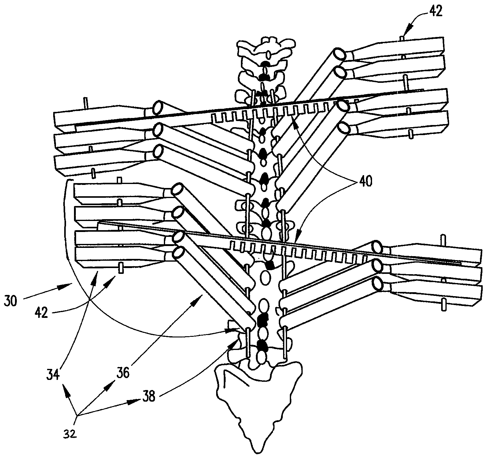 System and method for aligning vertebrae in the amelioration of aberrant spinal column deviation conditions