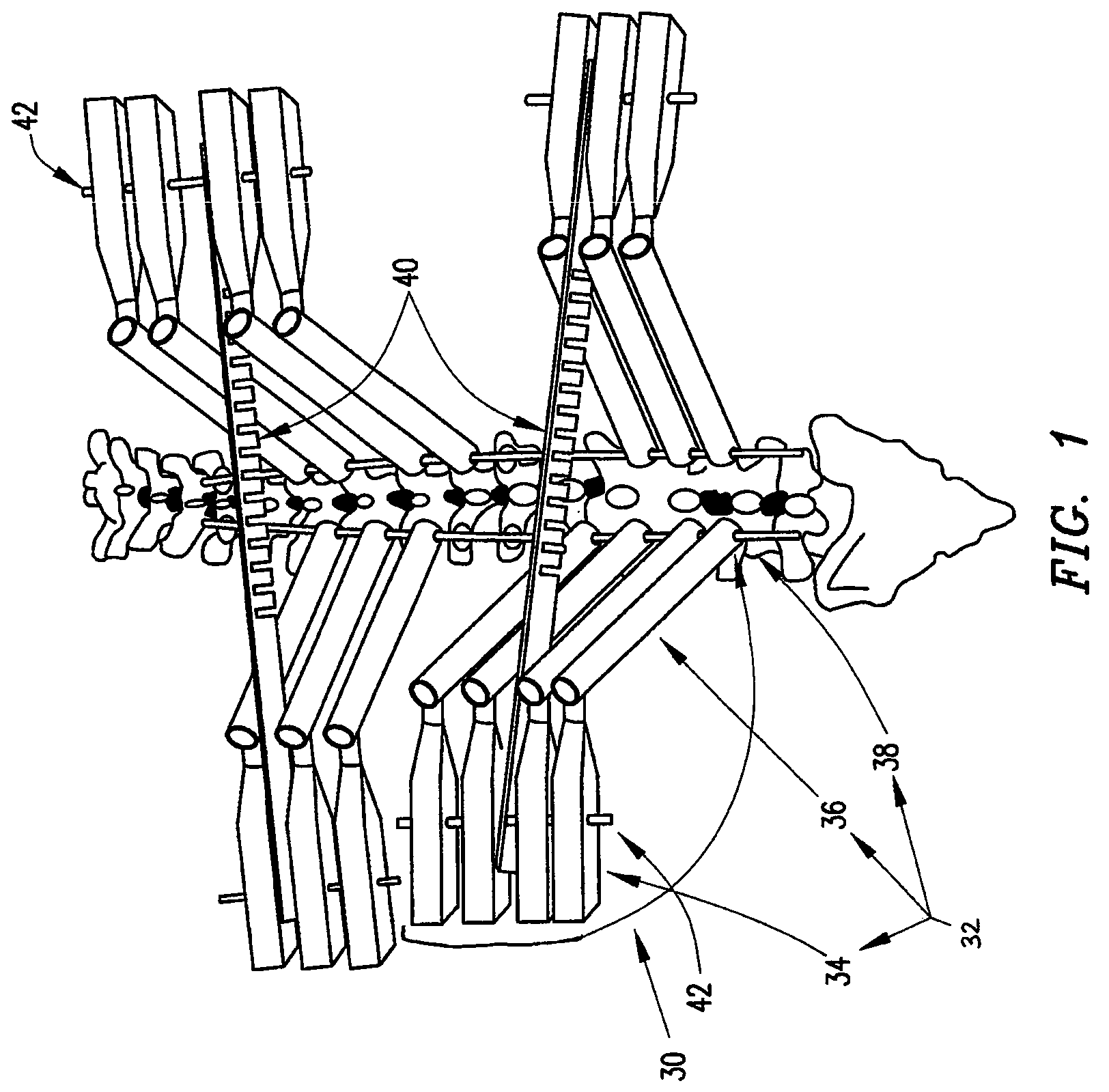 System and method for aligning vertebrae in the amelioration of aberrant spinal column deviation conditions