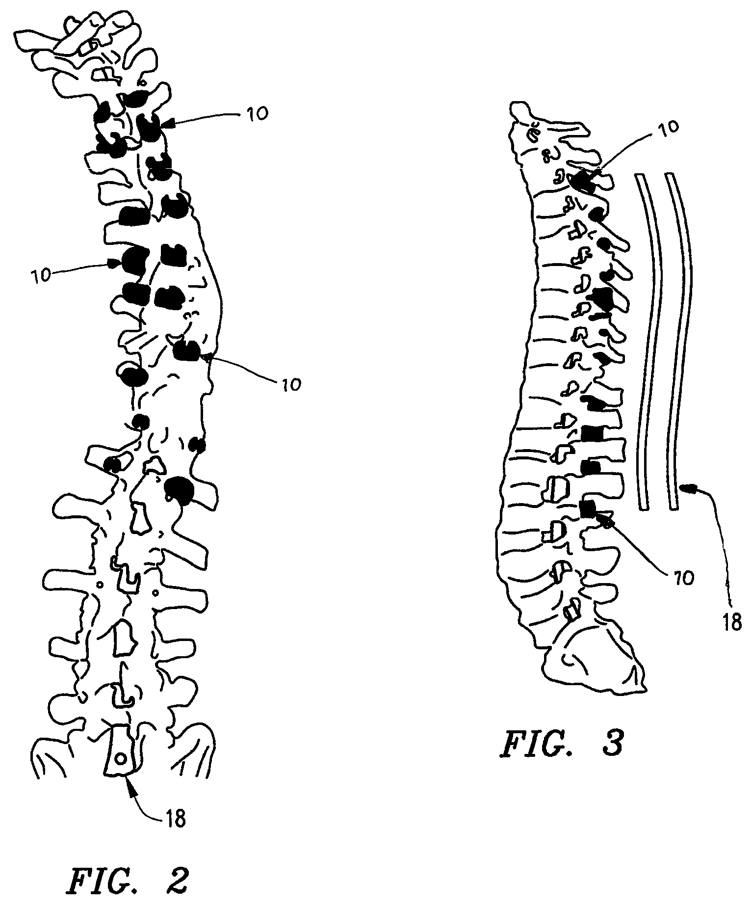 System and method for aligning vertebrae in the amelioration of aberrant spinal column deviation conditions