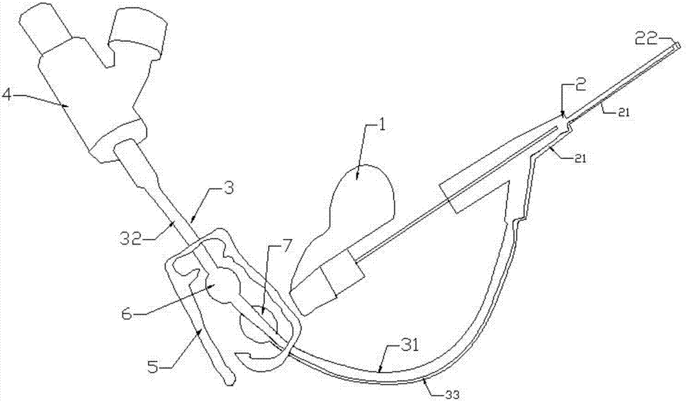 Double-saccule remaining needle