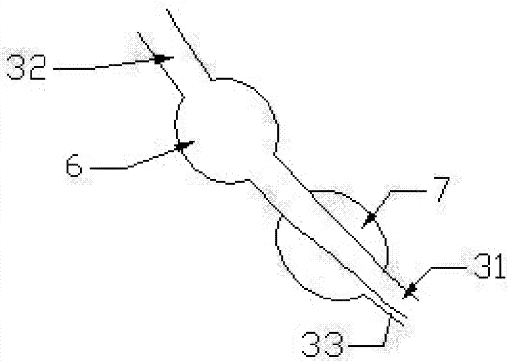 Double-saccule remaining needle