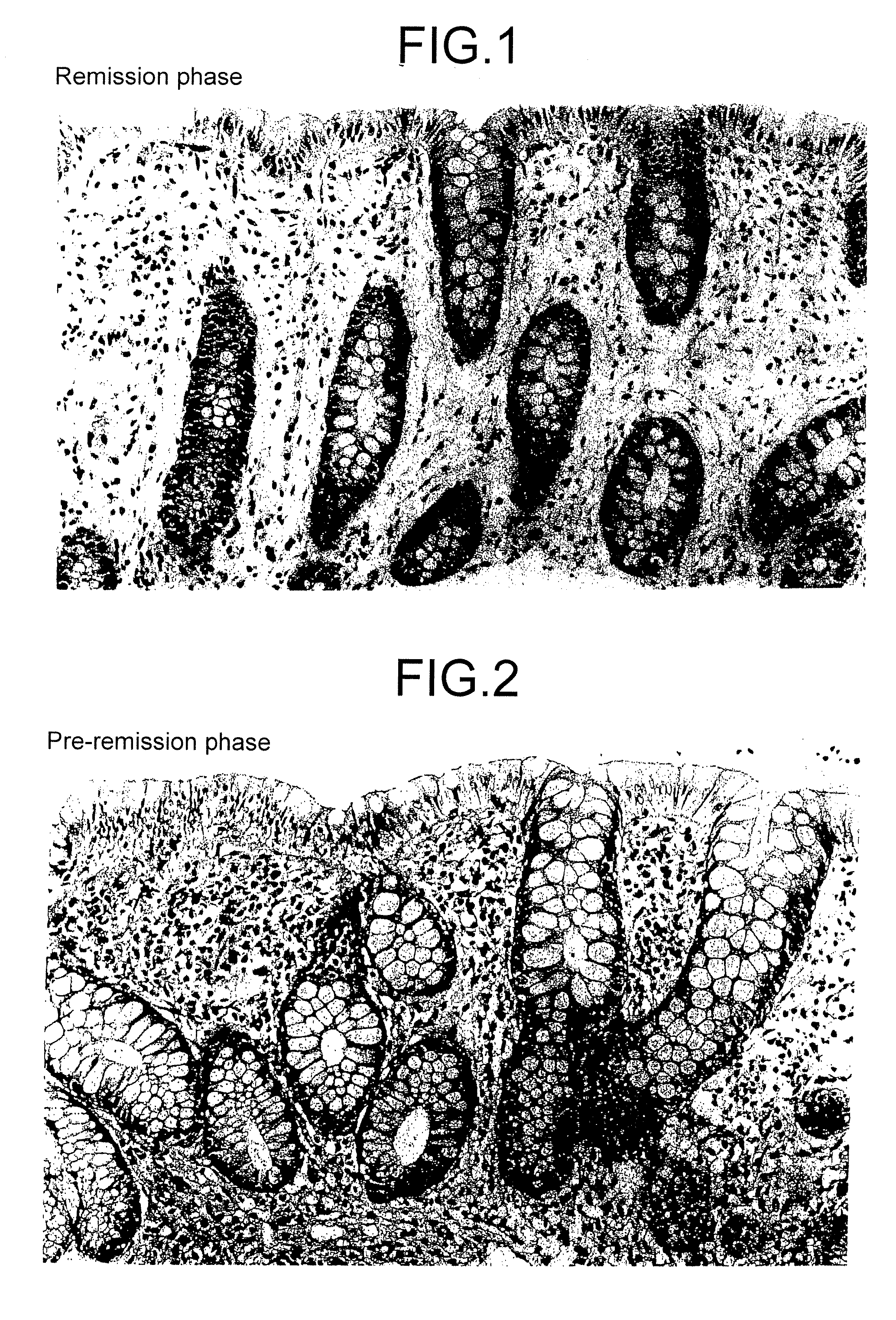 Method for determining the stage of ulcerative colitis or interstitial pneumonitis and reagent kit thereof