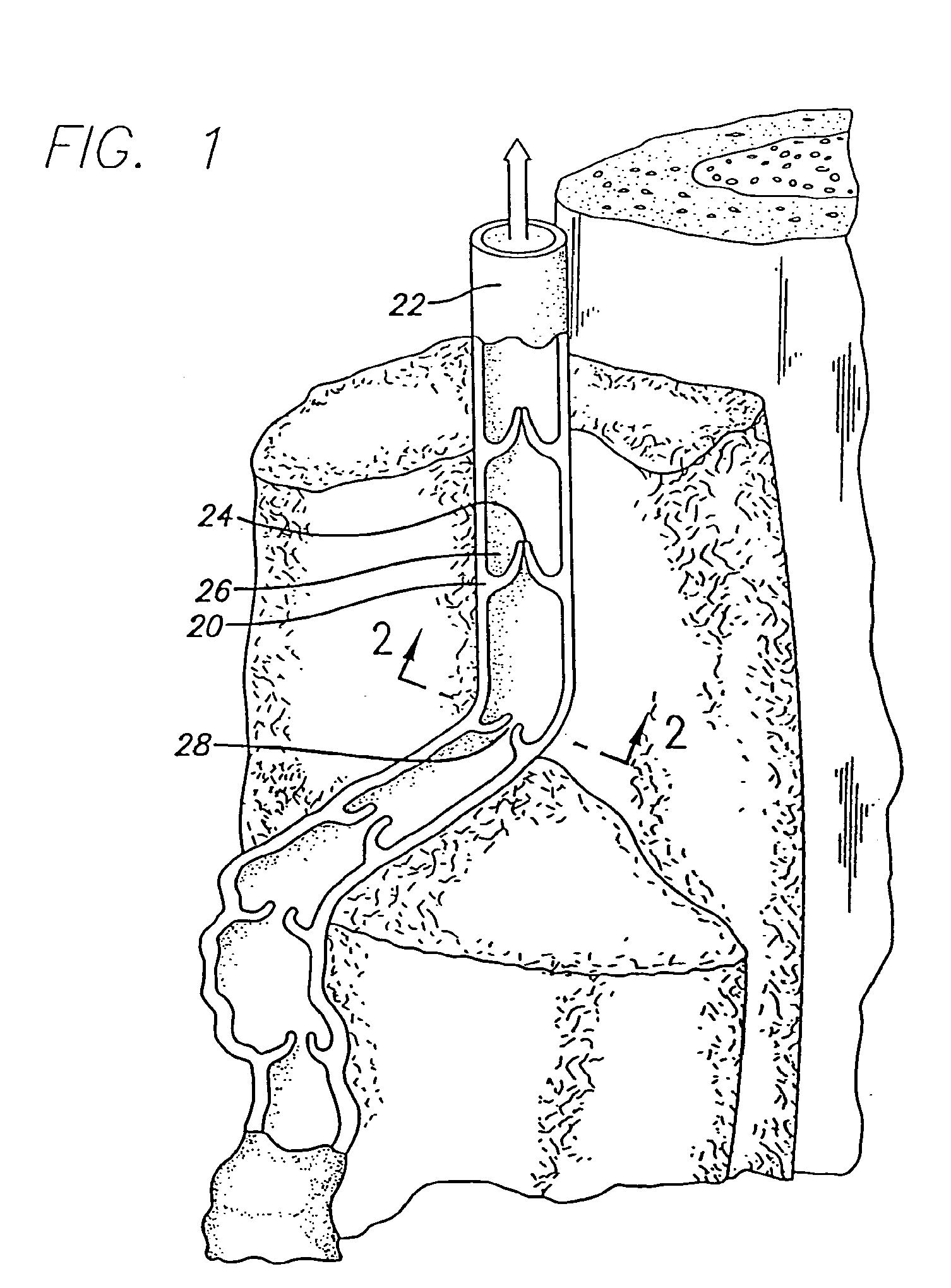 Method and apparatus for applying energy to biological tissue including the use of tumescent tissue compression