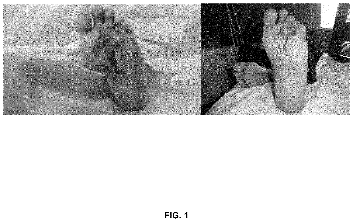 Topical semisolid composition containing an antimicrobial agent and pirfenidone for the treatment of chronic skin damage