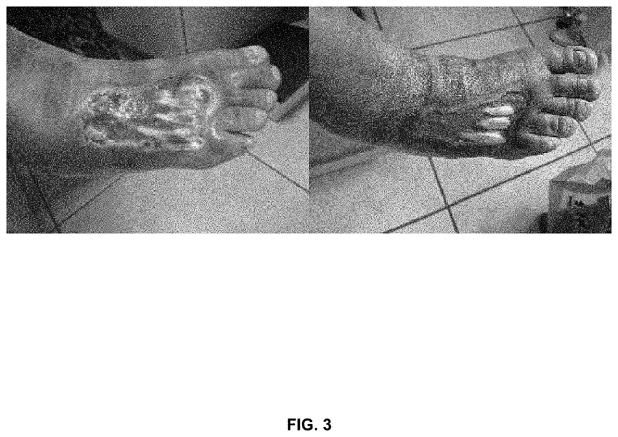 Topical semisolid composition containing an antimicrobial agent and pirfenidone for the treatment of chronic skin damage