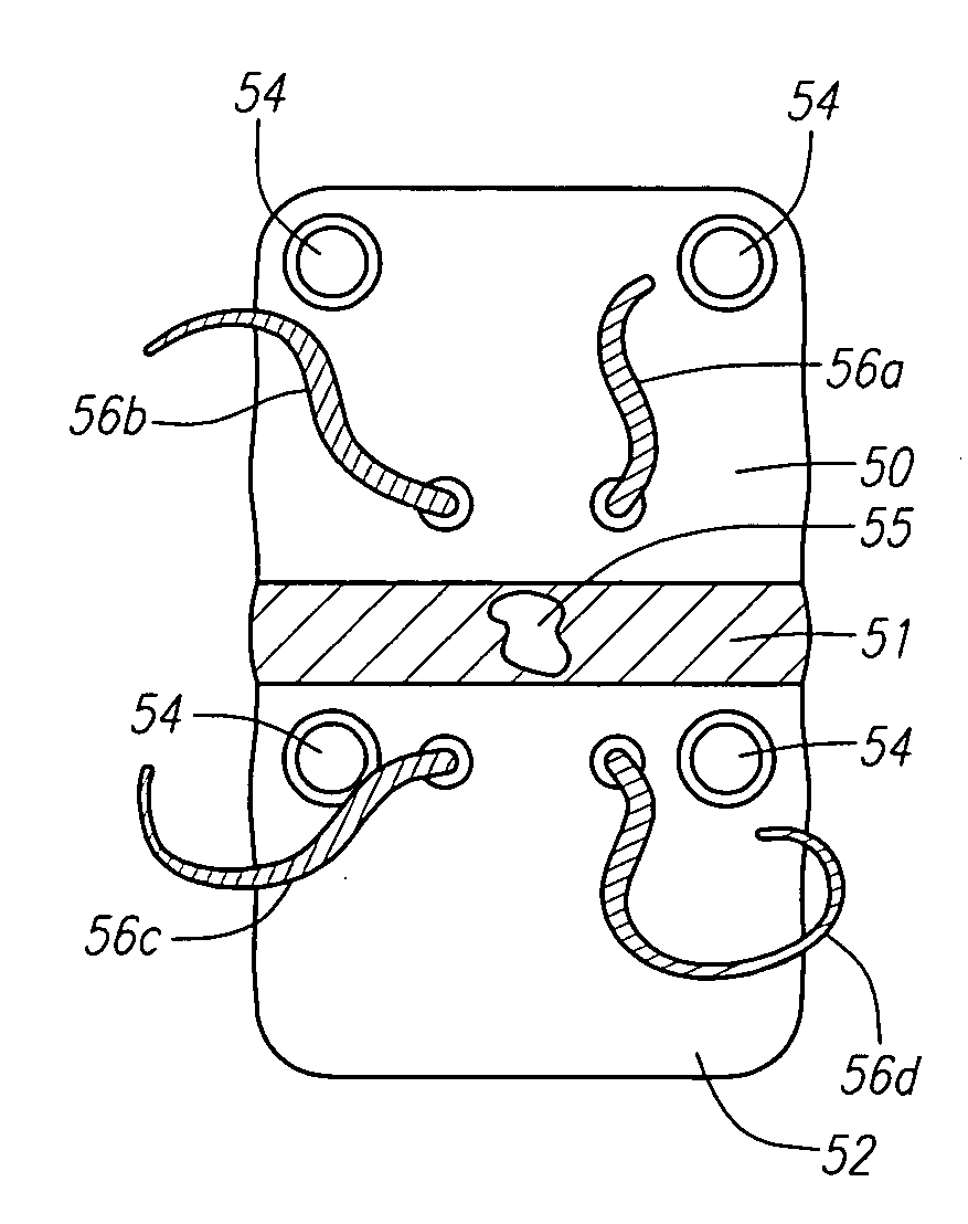 Sutures for use in the repair of defects in the anulus fibrosus