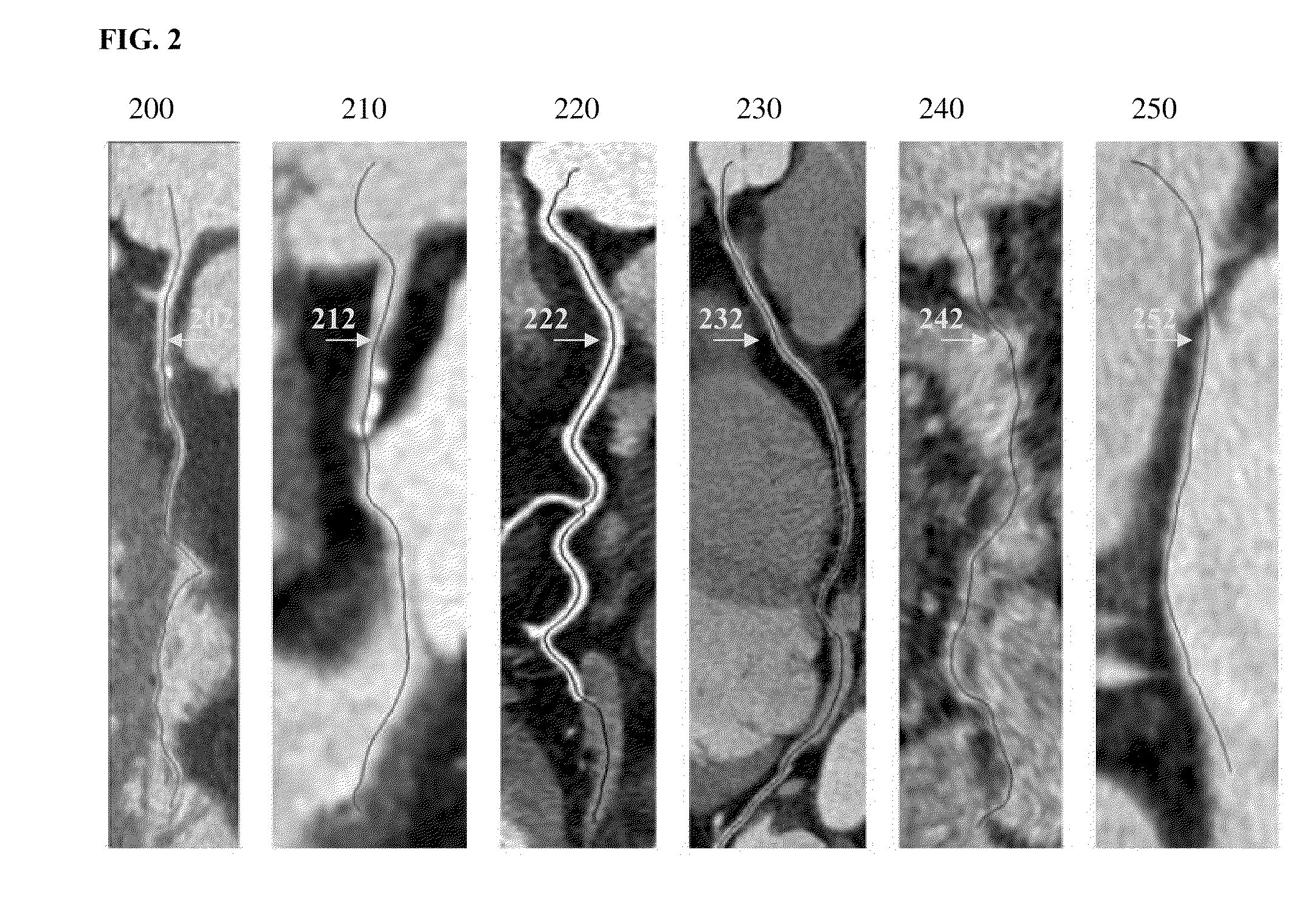 Method and System for Automatic Detection and Classification of Coronary Stenoses in Cardiac CT Volumes