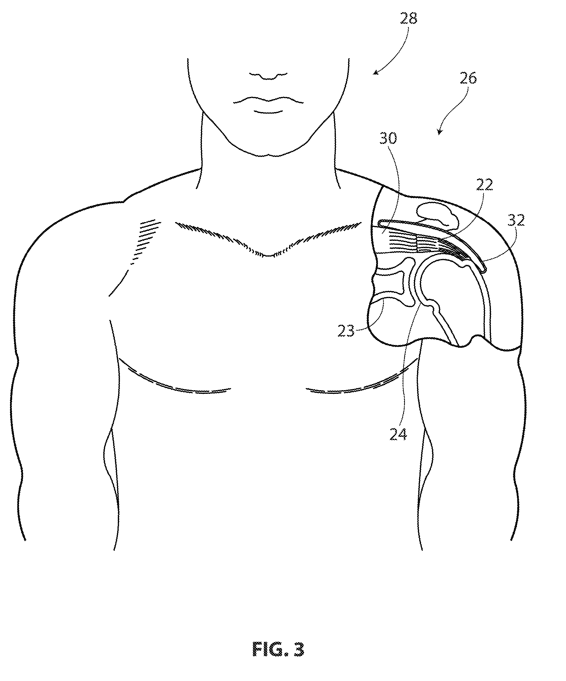 Tendon repair implant and method of arthroscopic implantation