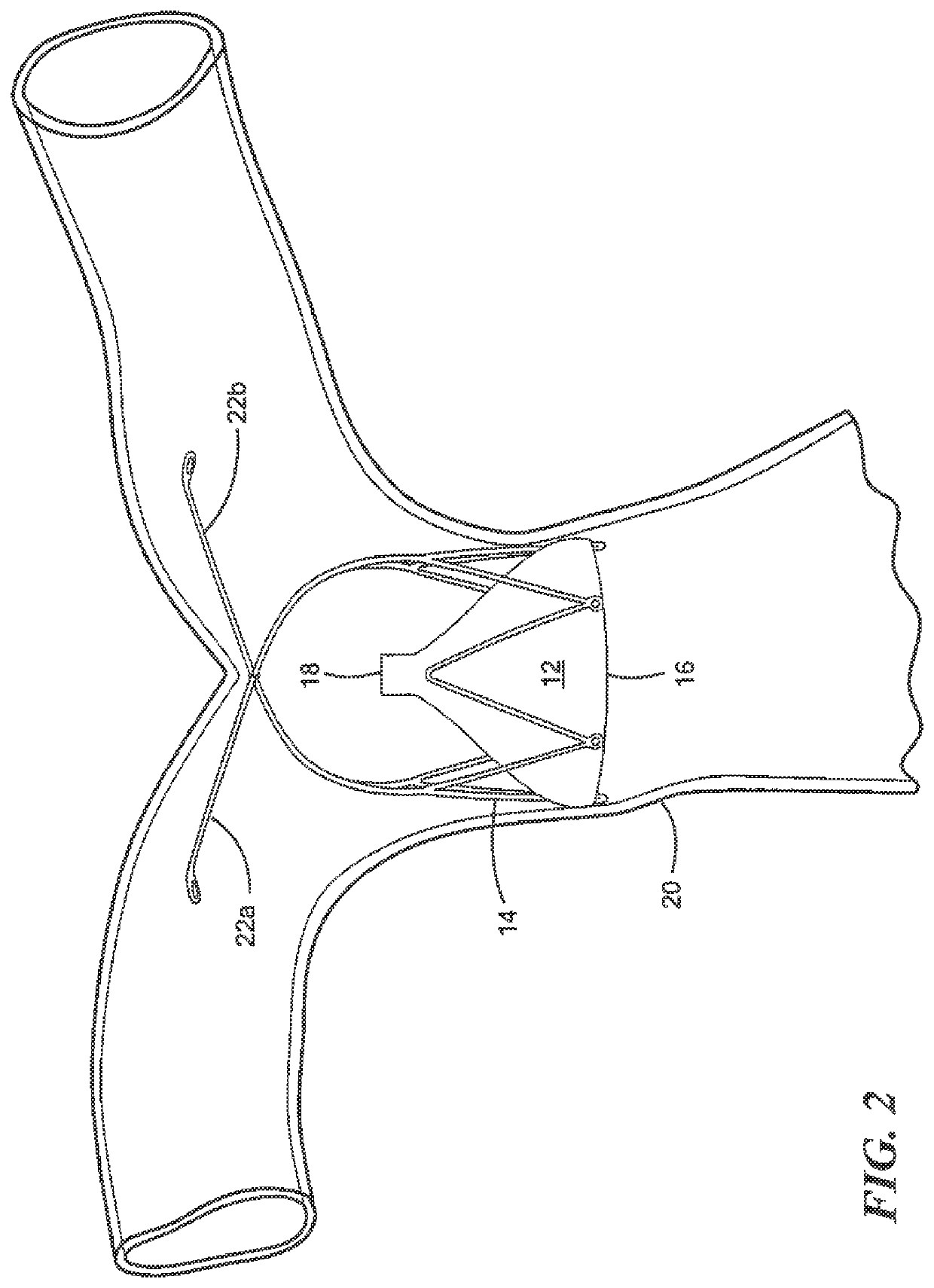 Transcatheter device and minimally invasive method for constricting and adjusting blood flow through a blood vessel