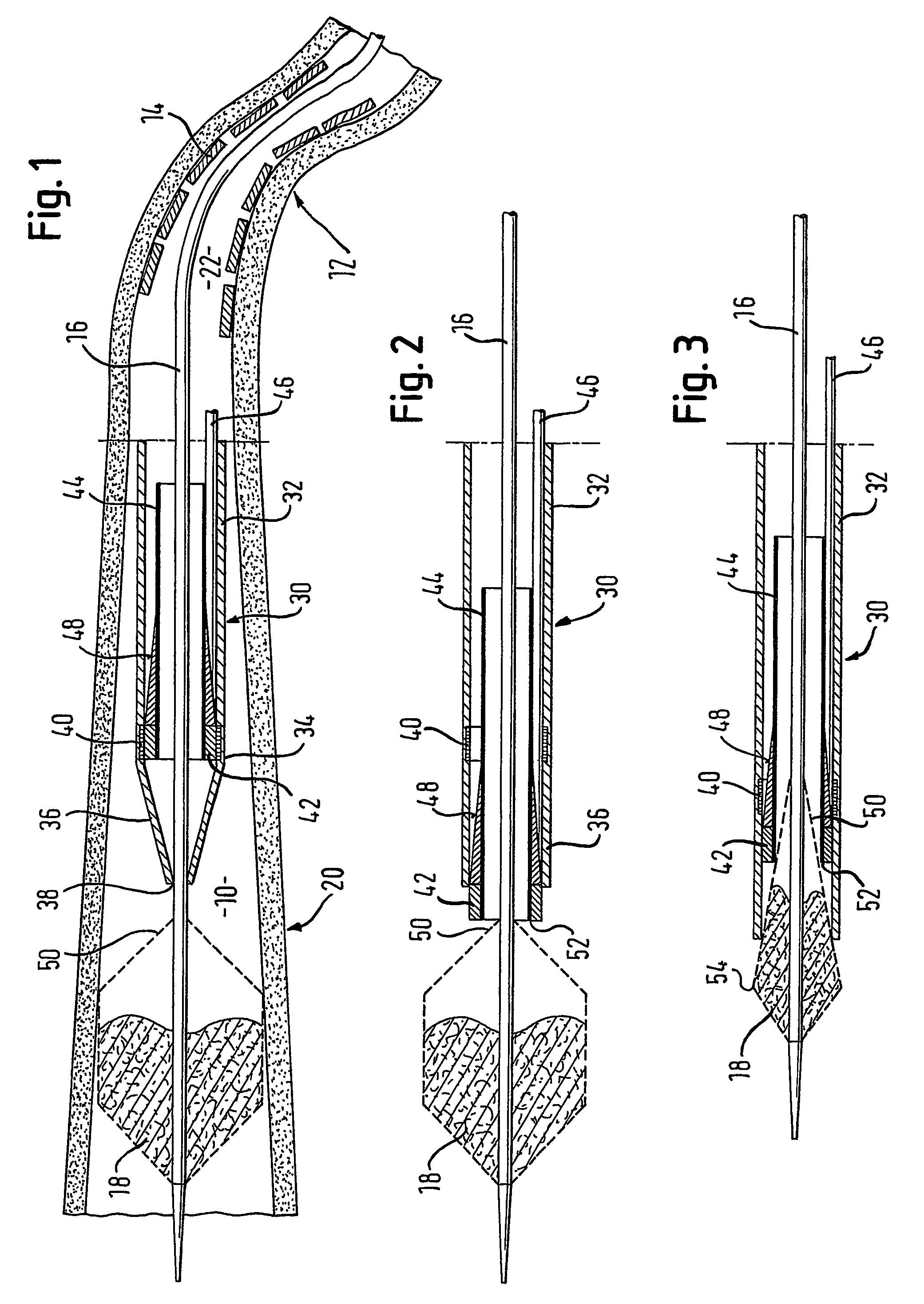 Retrieval catheter