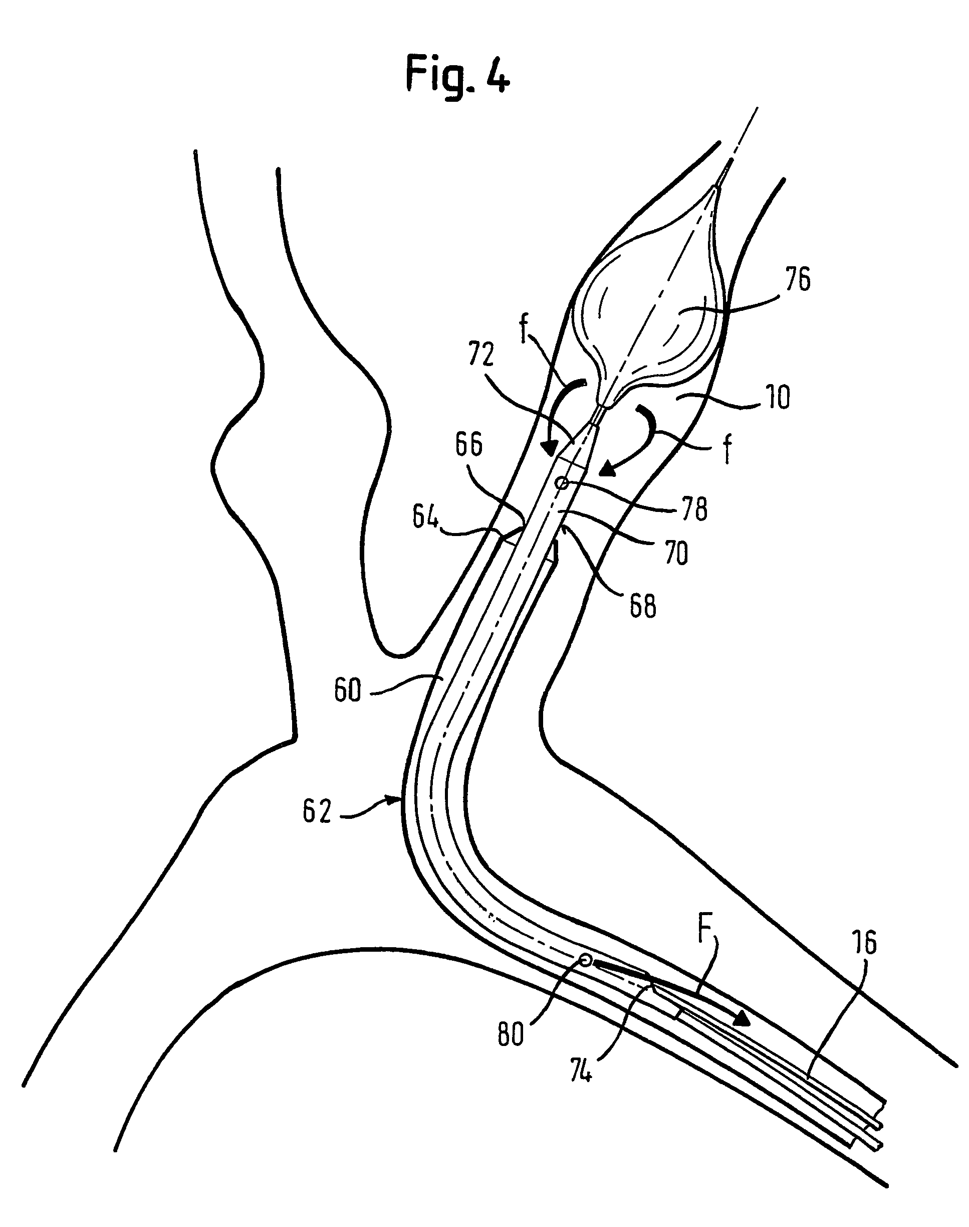 Retrieval catheter