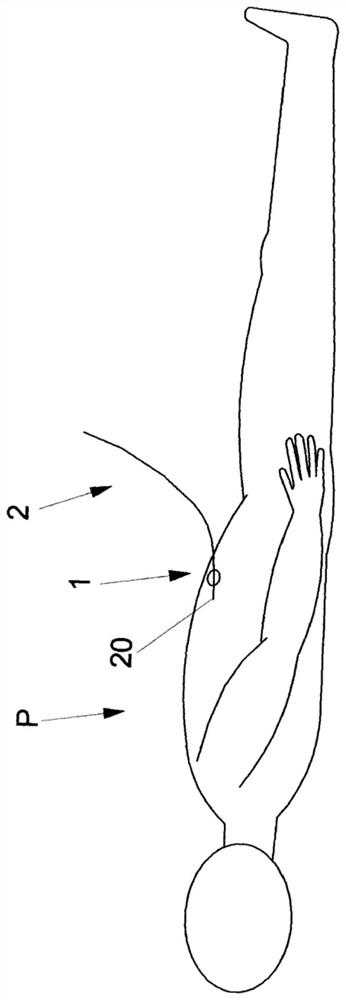 Retaining member for securing catheter to patient