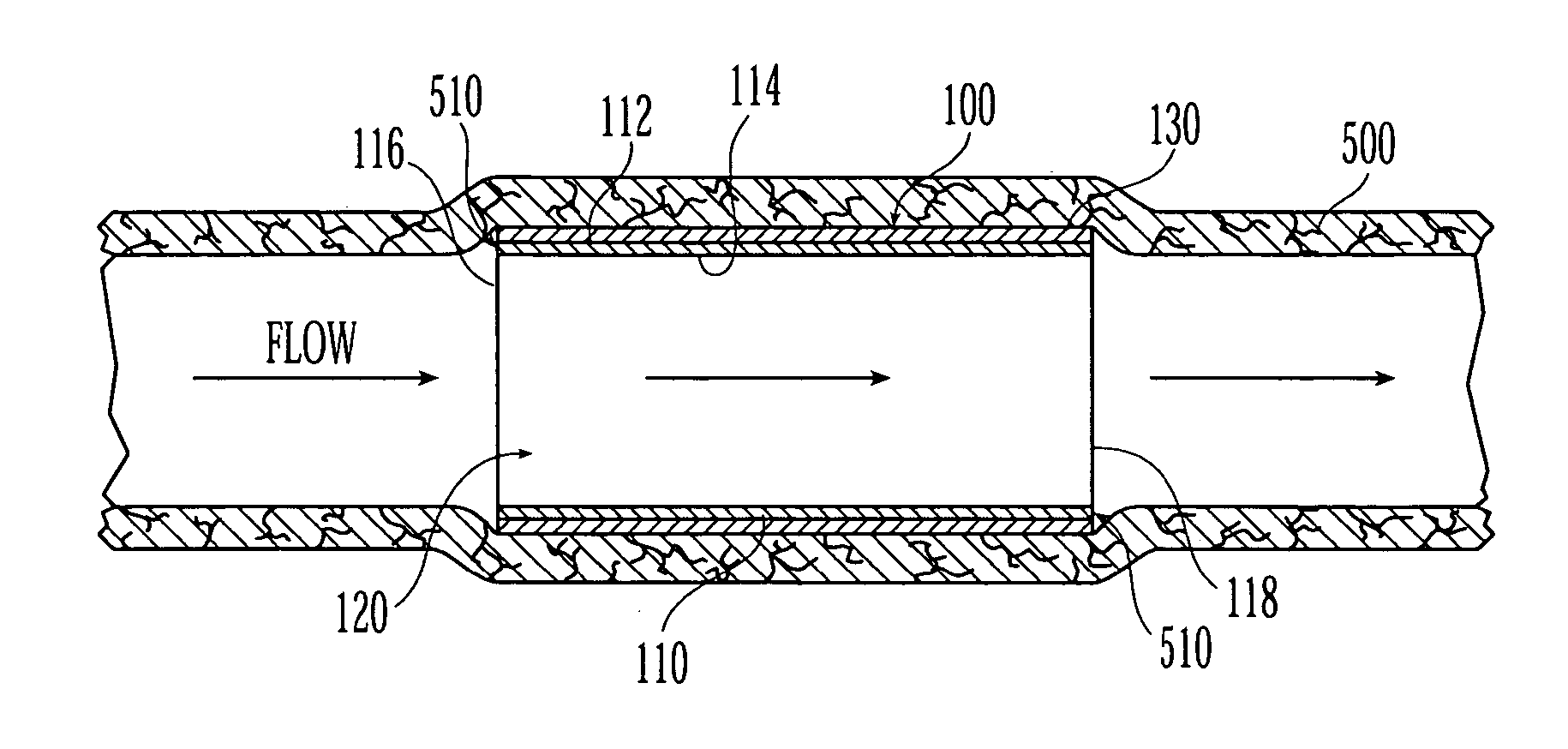 Stent system for preventing restenosis