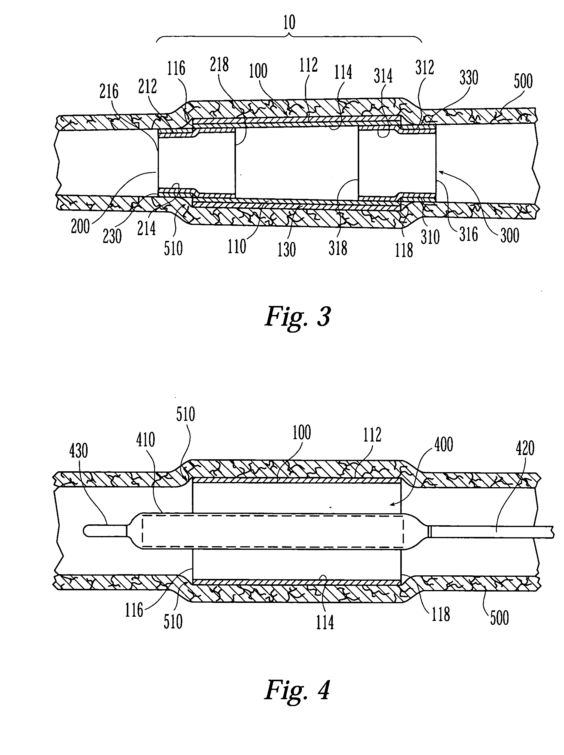 Stent system for preventing restenosis