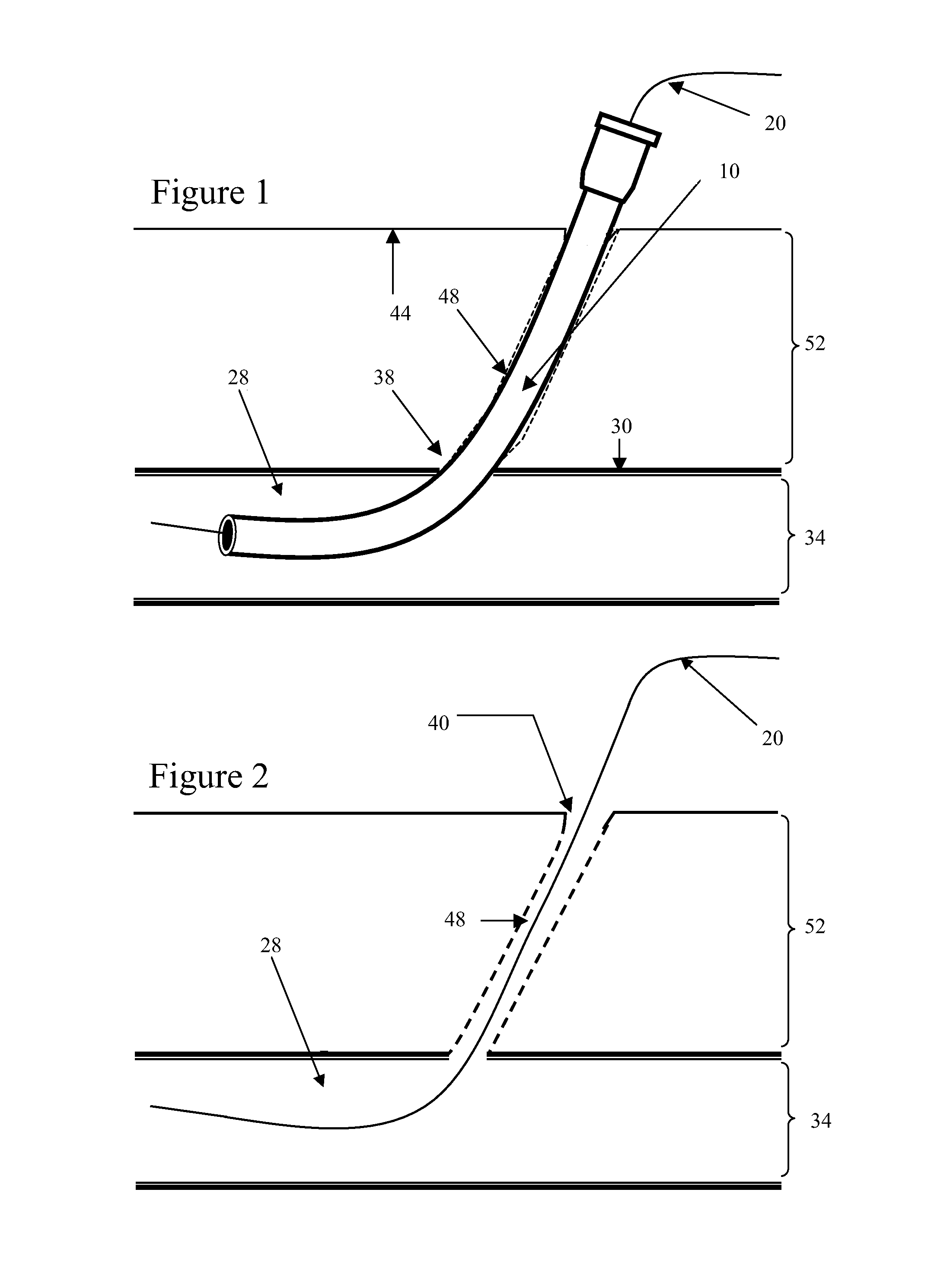 Hemostatic Bandage