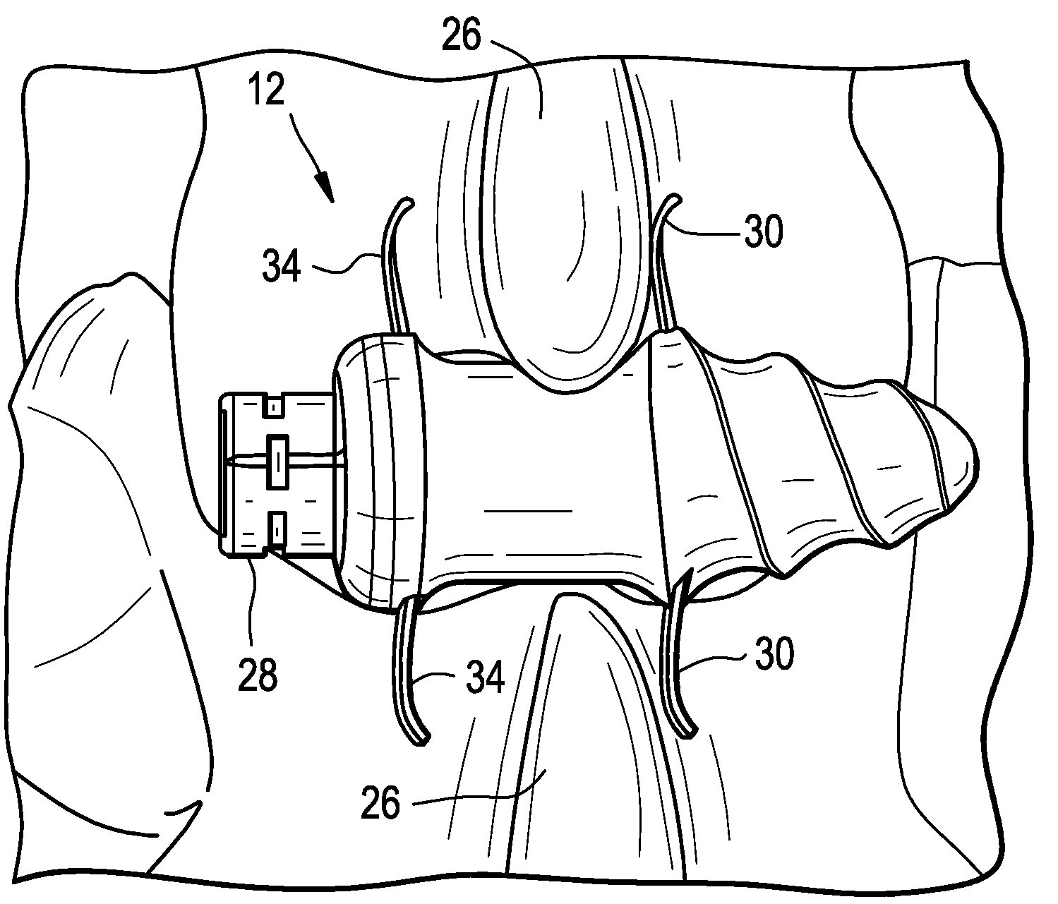 Conical interspinous apparatus and a method of performing interspinous distraction