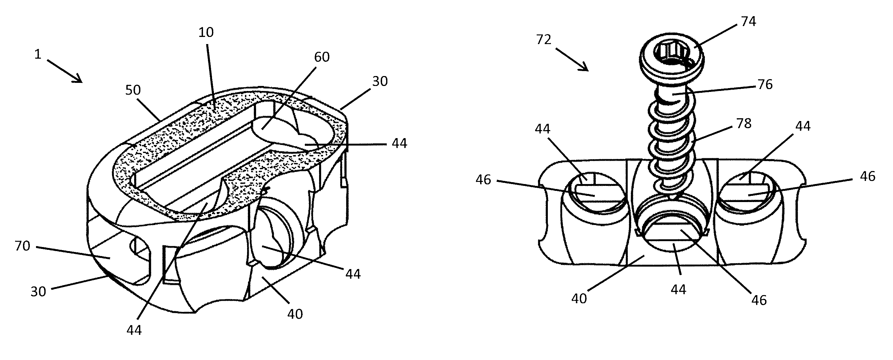 Self-deploying locking screw retention device