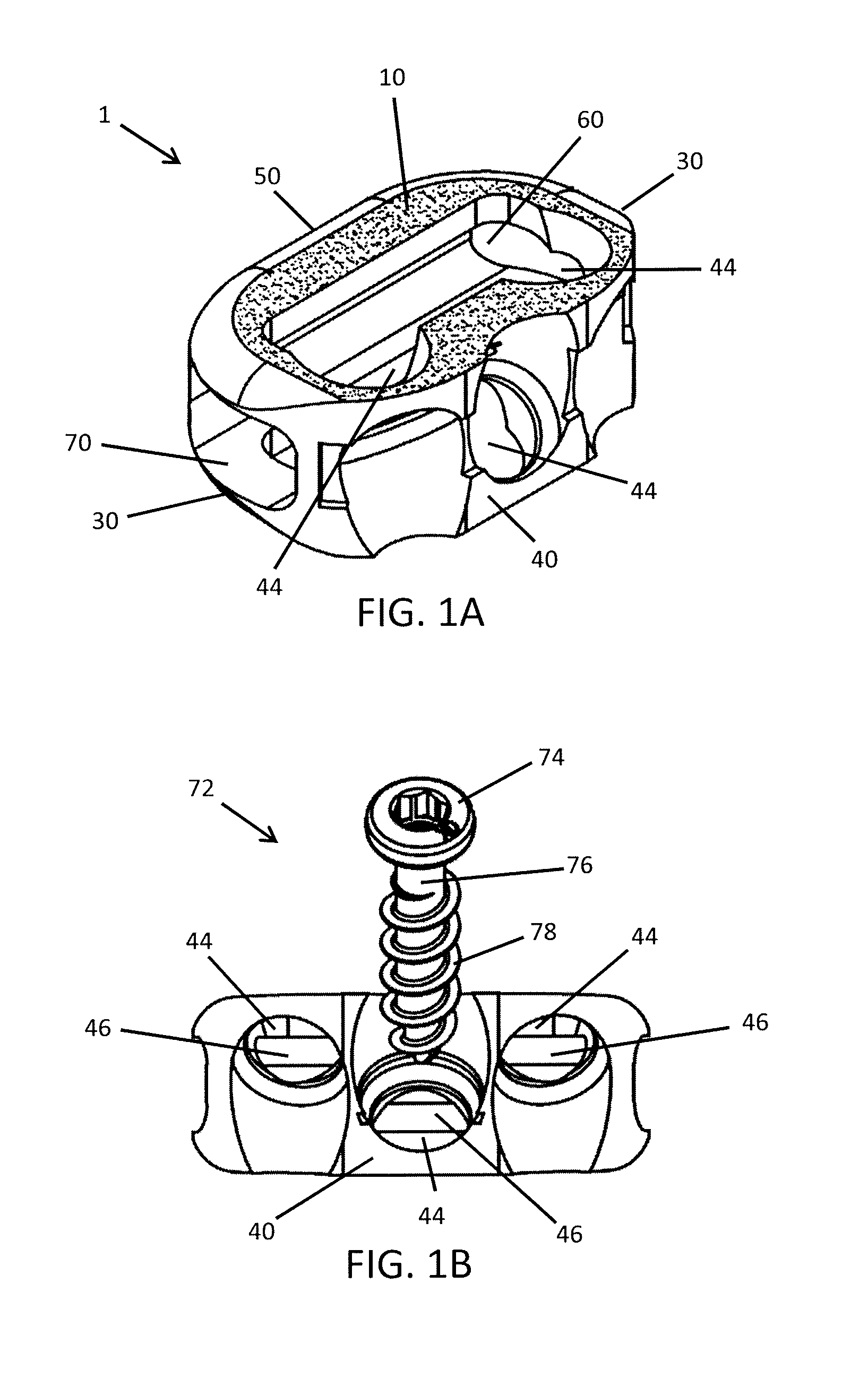 Self-deploying locking screw retention device