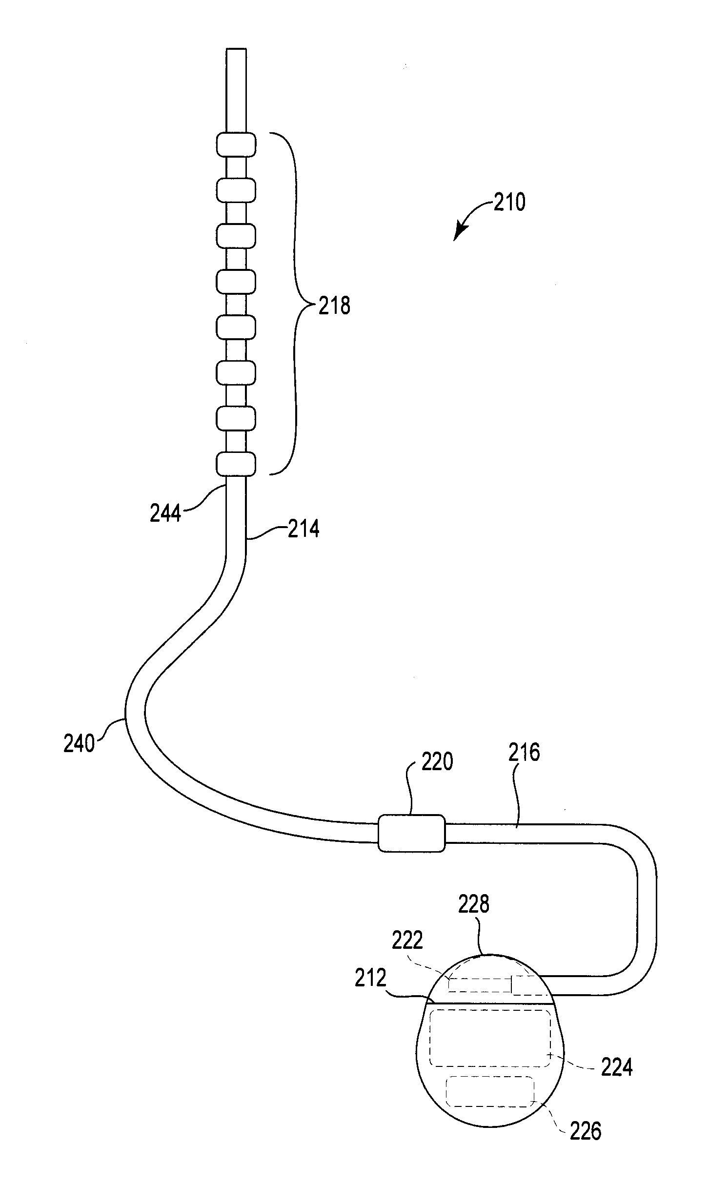 Pre-sutured anchor for implantable leads