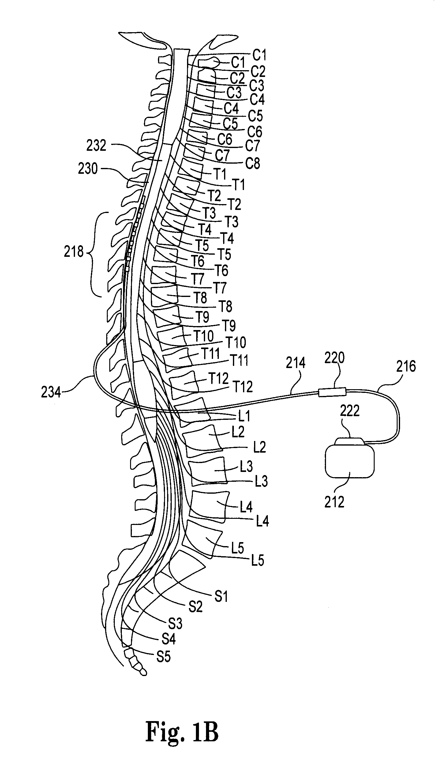 Pre-sutured anchor for implantable leads