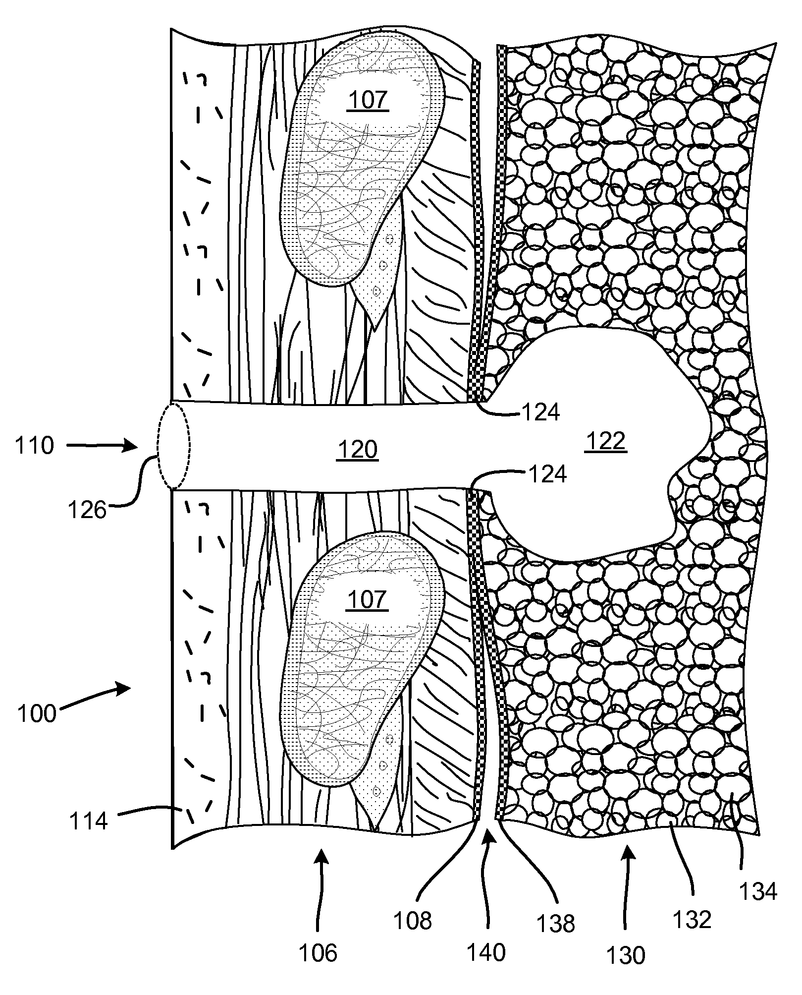 One-piece pneumostoma management system and methods for treatment of chronic obstructive pulmonary disease