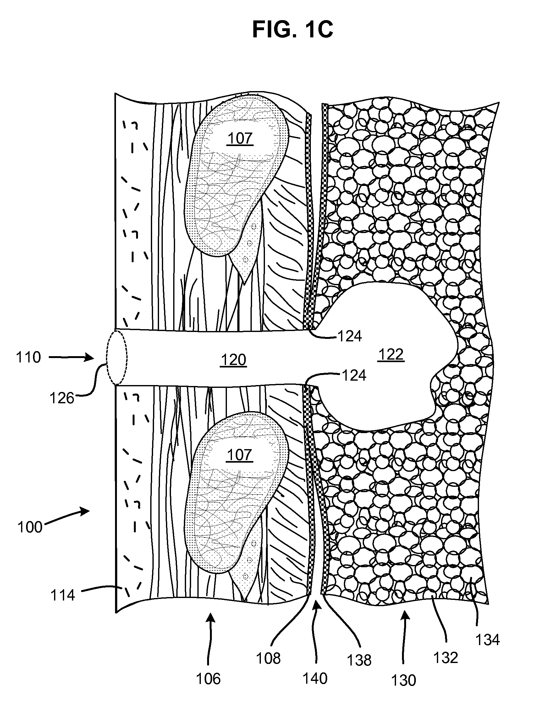 One-piece pneumostoma management system and methods for treatment of chronic obstructive pulmonary disease