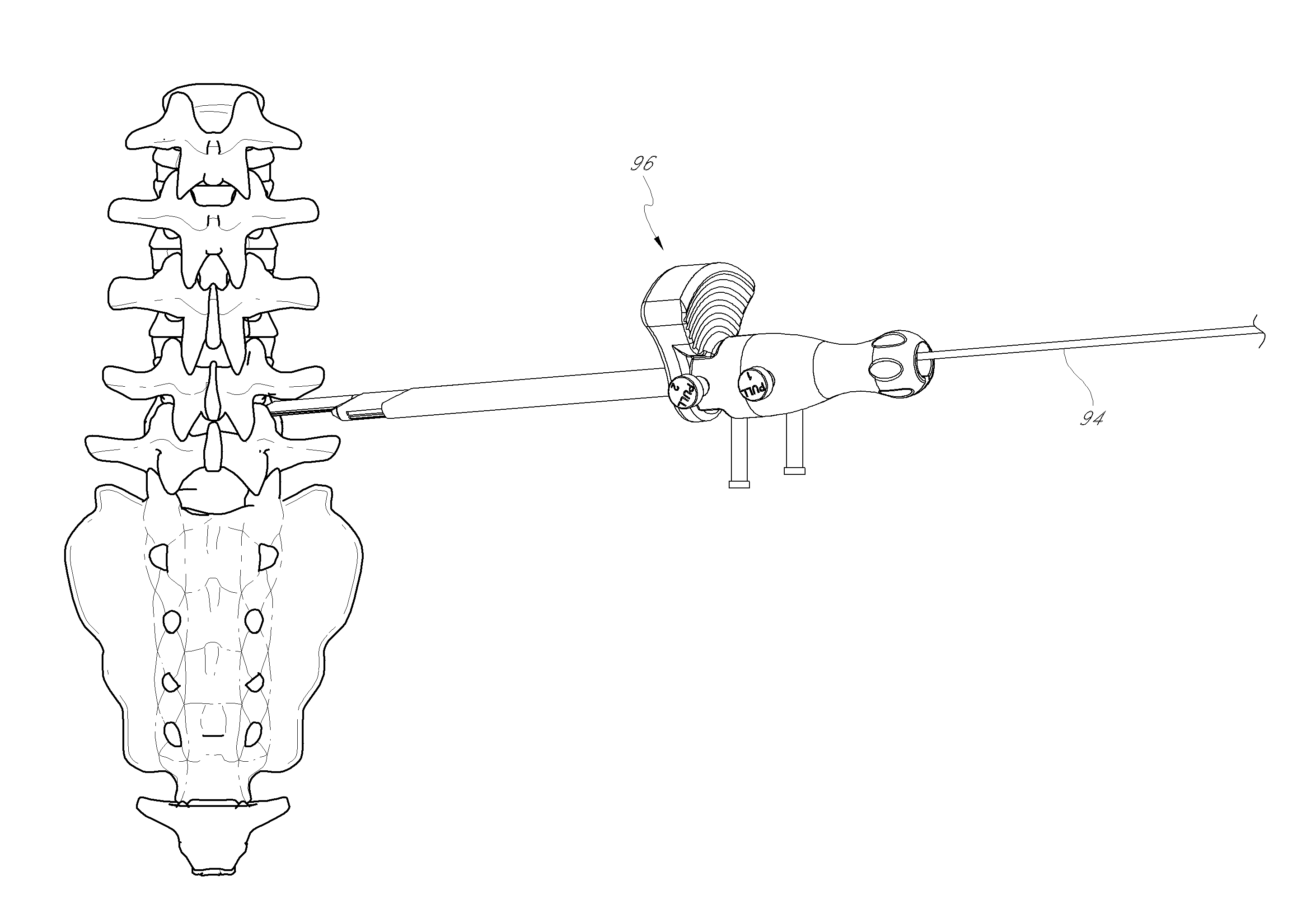 Method and apparatus for minimally invasive insertion of intervertebral implants