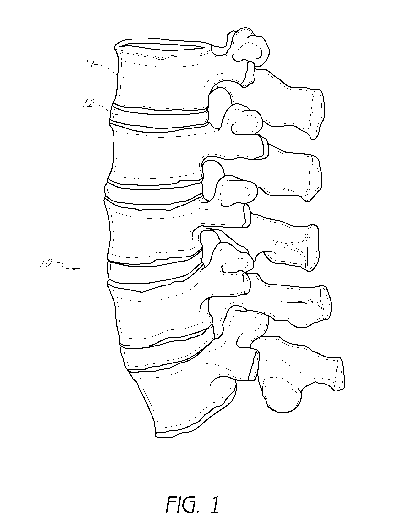 Method and apparatus for minimally invasive insertion of intervertebral implants