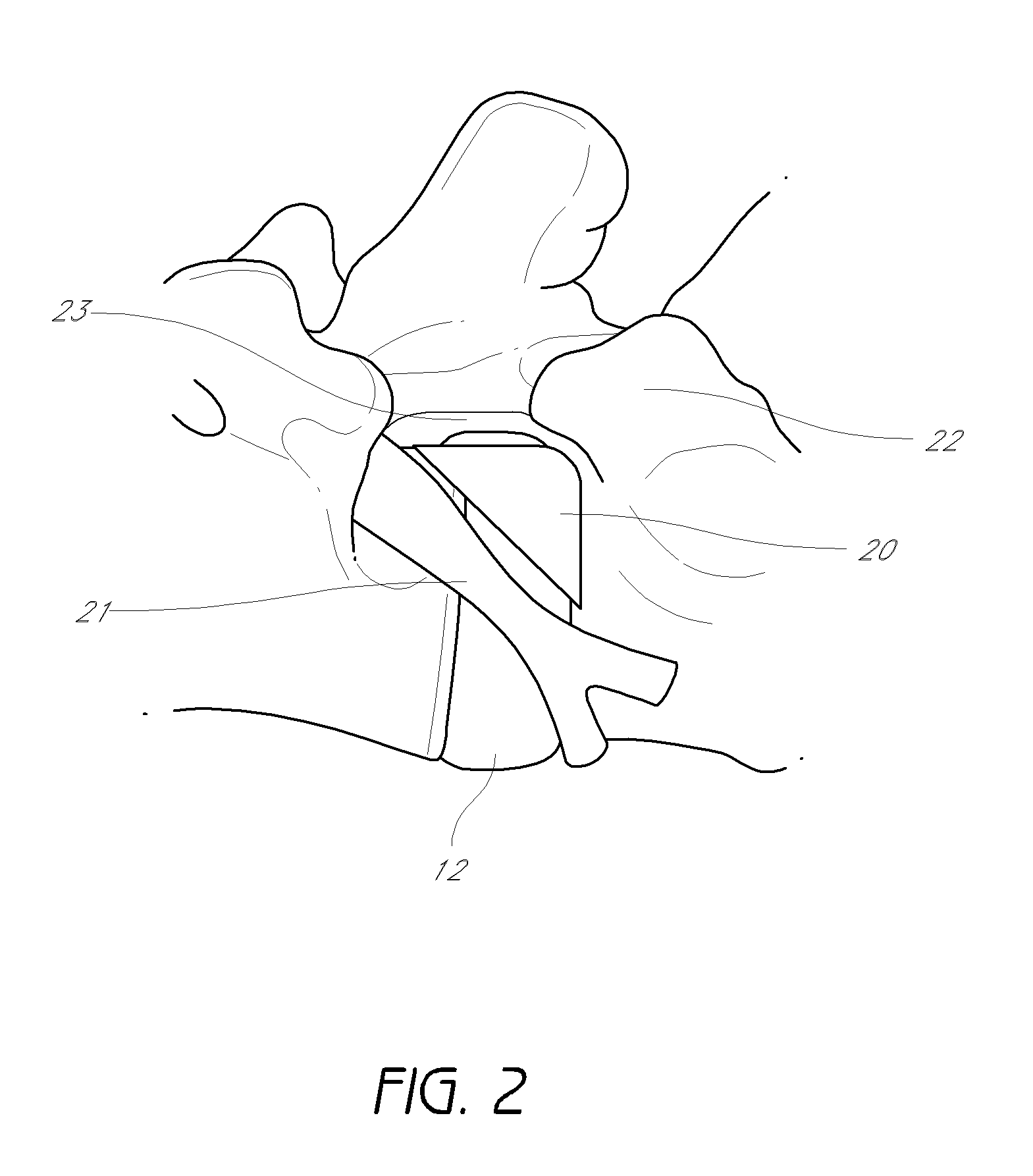 Method and apparatus for minimally invasive insertion of intervertebral implants